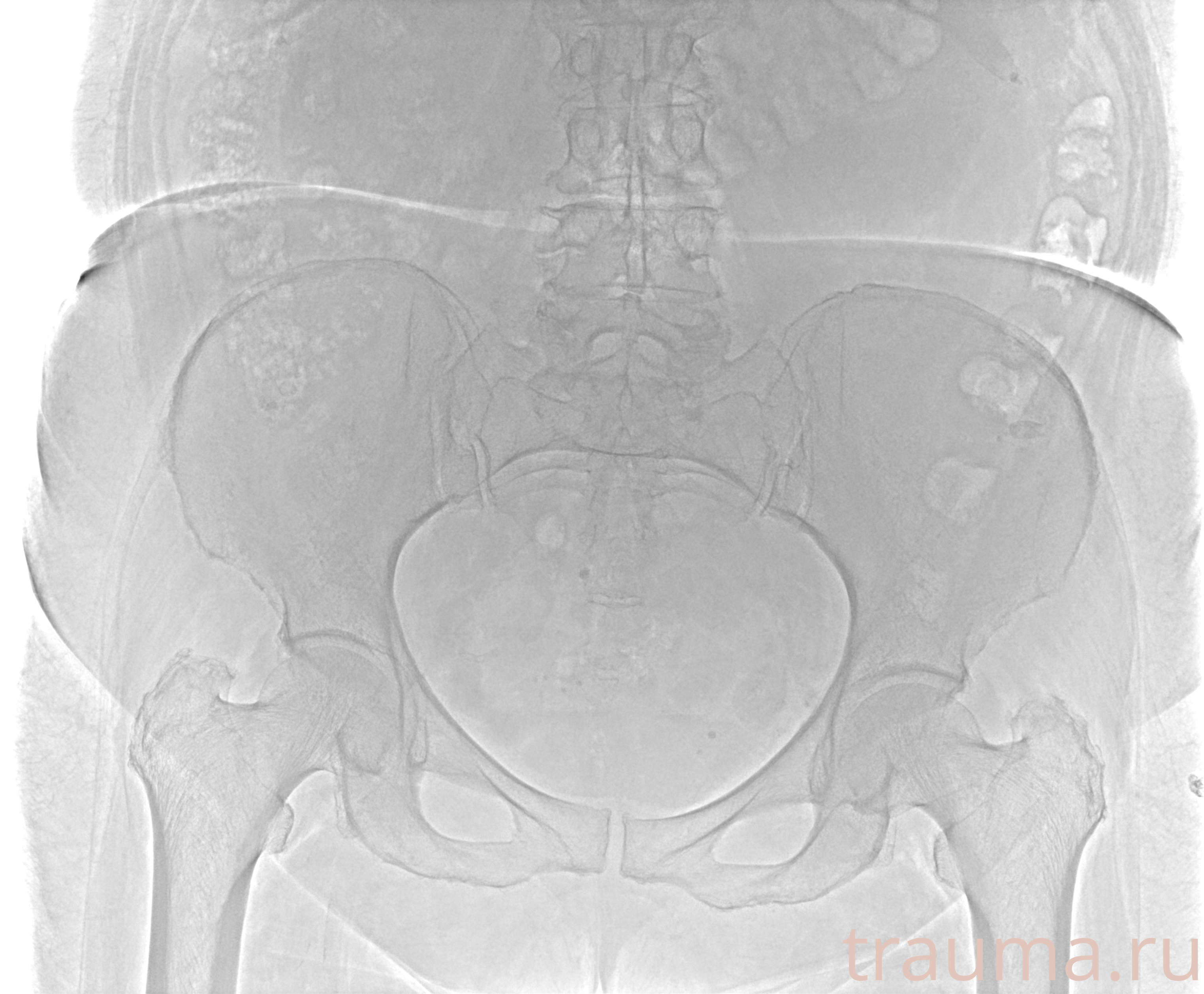 Рентген на дому: по вашему адресу приезжает врач-рентгенолог, травматолог-ортопед с мобильным рентгеновским аппаратом, проводит диагностику травмы или заболевания, делает необходимые рентгенограммы, дает рекомендации по дальнейшему лечению. Получить качественные снимки в домашних условиях возможно благодаря уникальной методике, разработанной МосРентген Центром для института  Склифосовского