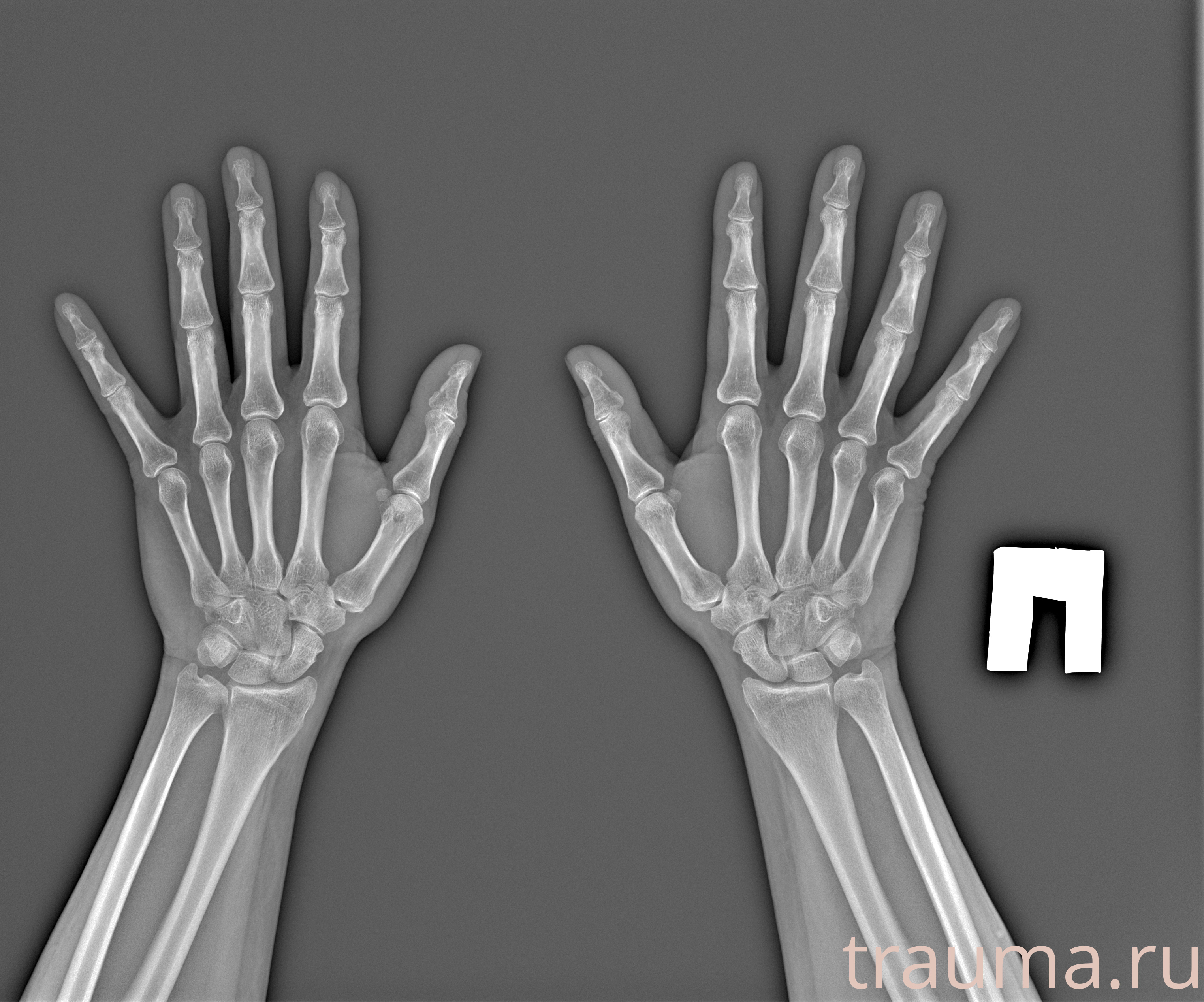 Рентген на дому: по вашему адресу приезжает врач-рентгенолог, травматолог-ортопед с мобильным рентгеновским аппаратом, проводит диагностику травмы или заболевания, делает необходимые рентгенограммы, дает рекомендации по дальнейшему лечению. Получить качественные снимки в домашних условиях возможно благодаря уникальной методике, разработанной МосРентген Центром для института  Склифосовского