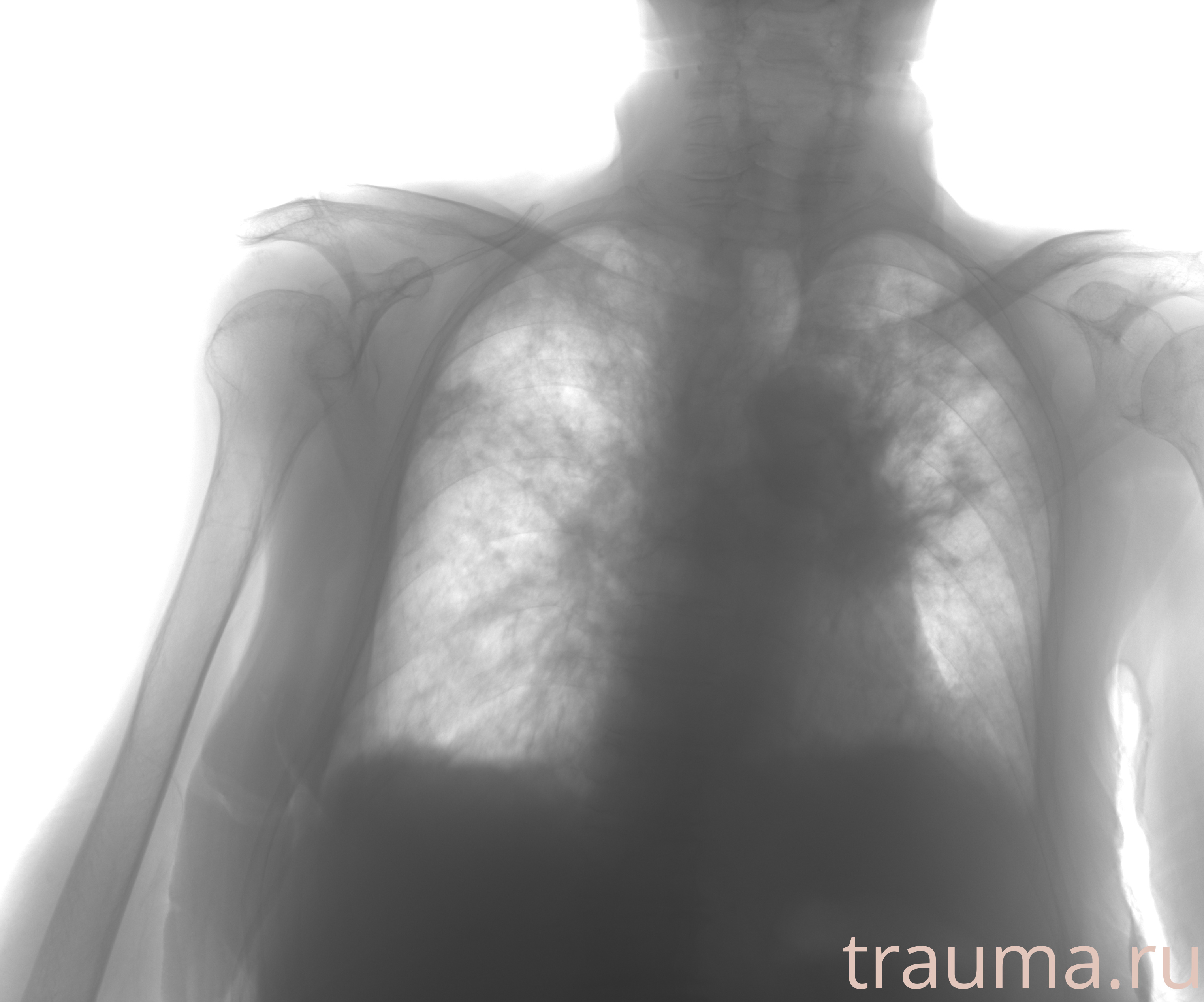 Рентген на дому: по вашему адресу приезжает врач-рентгенолог, травматолог-ортопед с мобильным рентгеновским аппаратом, проводит диагностику травмы или заболевания, делает необходимые рентгенограммы, дает рекомендации по дальнейшему лечению. Получить качественные снимки в домашних условиях возможно благодаря уникальной методике, разработанной МосРентген Центром для института  Склифосовского