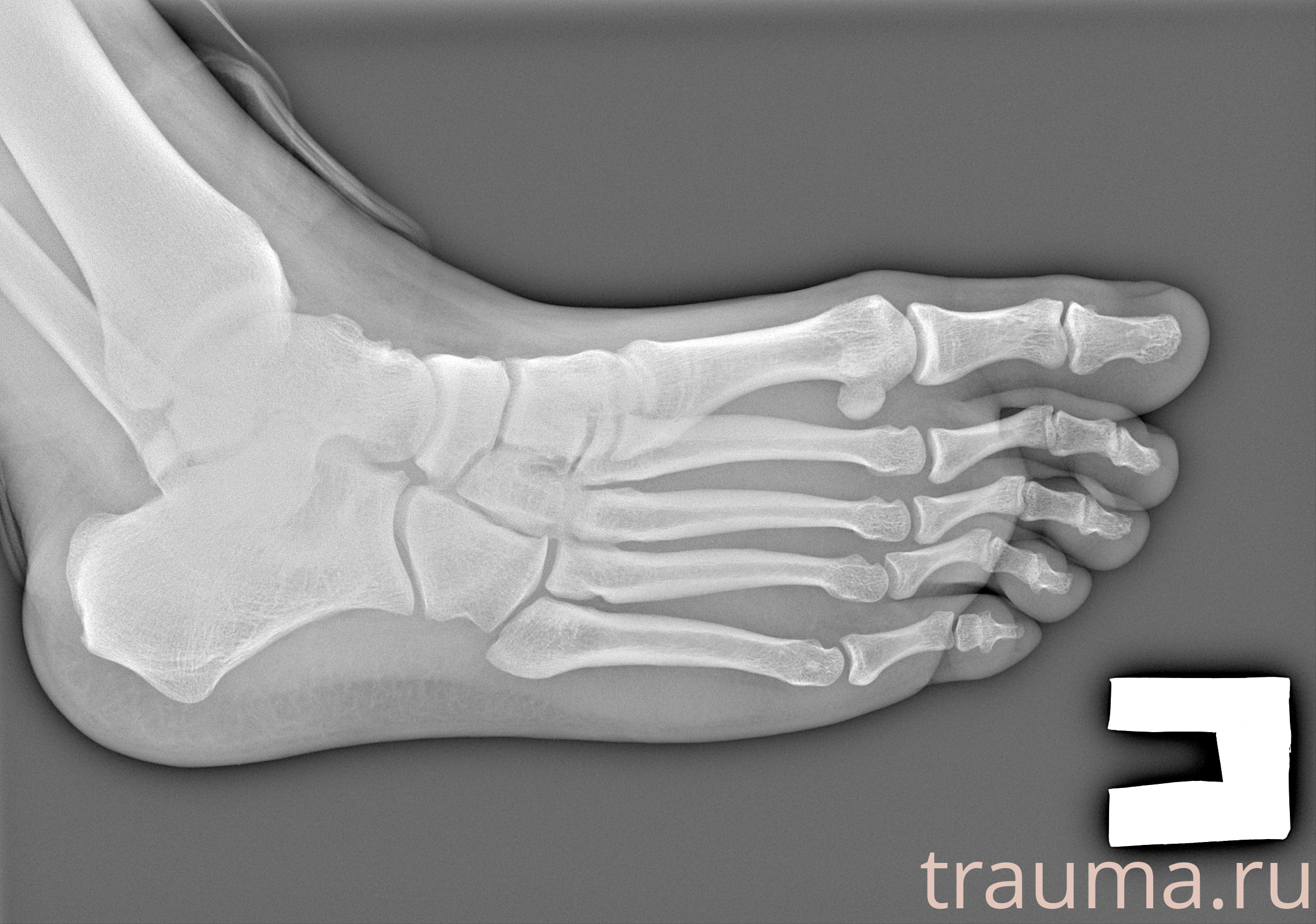 Рентген на дому: по вашему адресу приезжает врач-рентгенолог, травматолог-ортопед с мобильным рентгеновским аппаратом, проводит диагностику травмы или заболевания, делает необходимые рентгенограммы, дает рекомендации по дальнейшему лечению. Получить качественные снимки в домашних условиях возможно благодаря уникальной методике, разработанной МосРентген Центром для института  Склифосовского