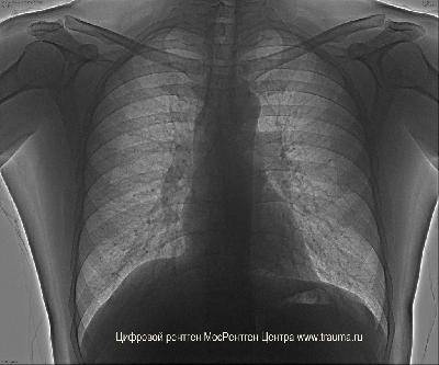 Трахея и бронхи на рентгенограмме грудной клетки