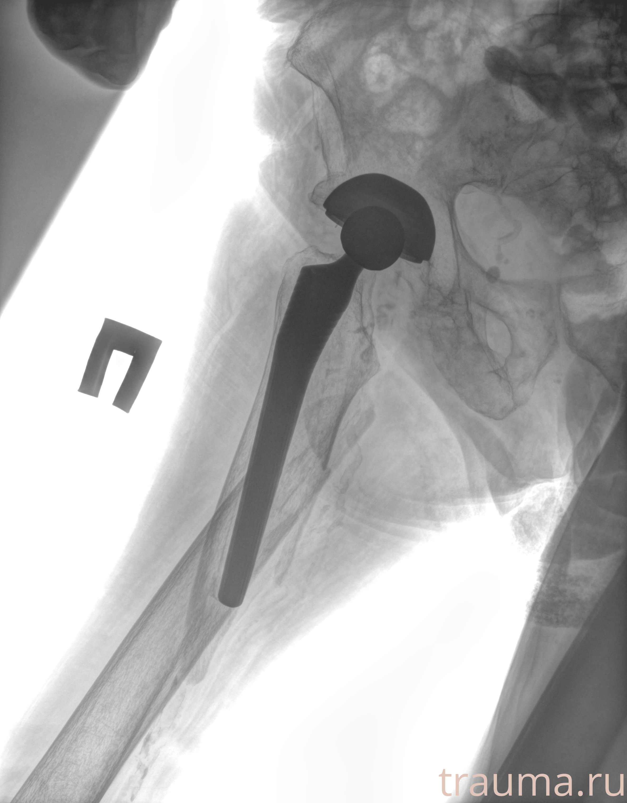 Рентген на дому: по вашему адресу приезжает врач-рентгенолог, травматолог-ортопед с мобильным рентгеновским аппаратом, проводит диагностику травмы или заболевания, делает необходимые рентгенограммы, дает рекомендации по дальнейшему лечению. Получить качественные снимки в домашних условиях возможно благодаря уникальной методике, разработанной МосРентген Центром для института  Склифосовского