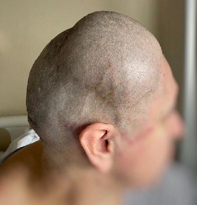 Пациентка попала в Склиф с жалобами на новообразование Пациентка попала в Склиф с жалобами на новообразование