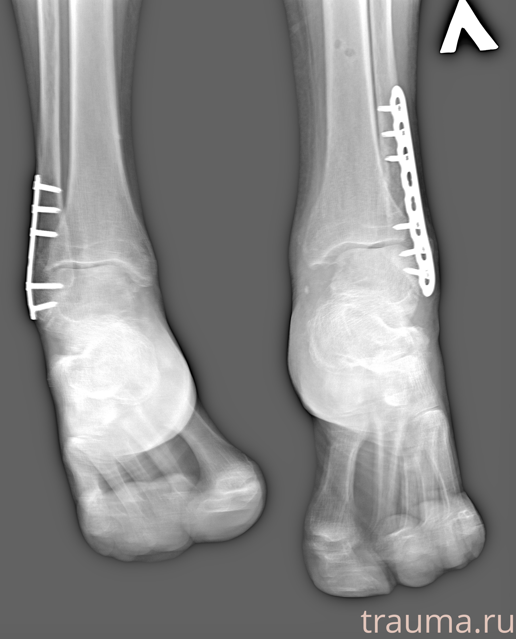 Рентген на дому: по вашему адресу приезжает врач-рентгенолог, травматолог-ортопед с мобильным рентгеновским аппаратом, проводит диагностику травмы или заболевания, делает необходимые рентгенограммы, дает рекомендации по дальнейшему лечению. Получить качественные снимки в домашних условиях возможно благодаря уникальной методике, разработанной МосРентген Центром для института  Склифосовского