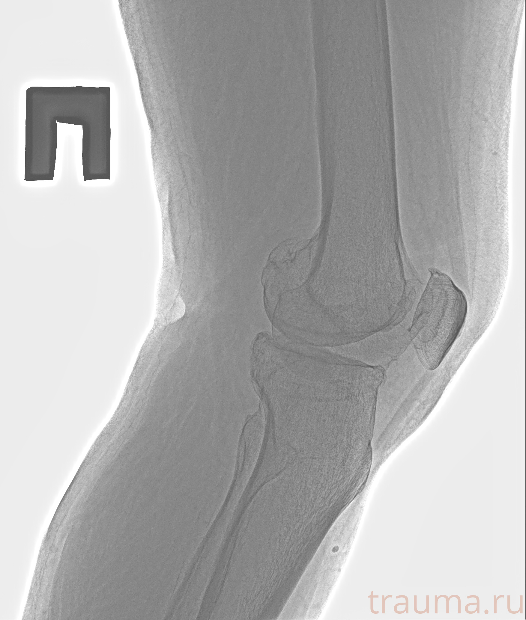 Рентген на дому: по вашему адресу приезжает врач-рентгенолог, травматолог-ортопед с мобильным рентгеновским аппаратом, проводит диагностику травмы или заболевания, делает необходимые рентгенограммы, дает рекомендации по дальнейшему лечению. Получить качественные снимки в домашних условиях возможно благодаря уникальной методике, разработанной МосРентген Центром для института  Склифосовского