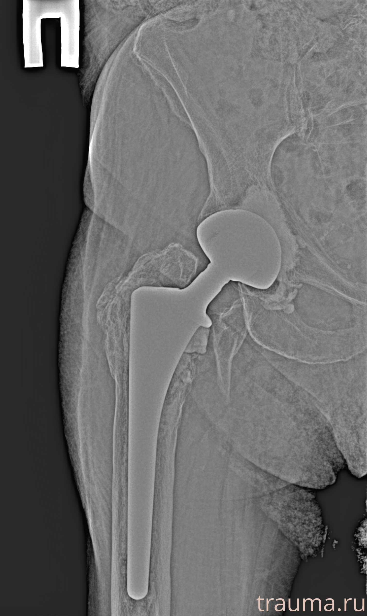 Рентген на дому: по вашему адресу приезжает врач-рентгенолог, травматолог-ортопед с мобильным рентгеновским аппаратом, проводит диагностику травмы или заболевания, делает необходимые рентгенограммы, дает рекомендации по дальнейшему лечению. Получить качественные снимки в домашних условиях возможно благодаря уникальной методике, разработанной МосРентген Центром для института  Склифосовского