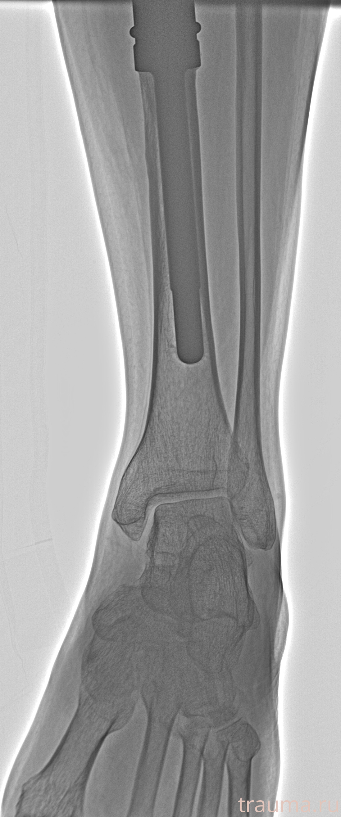 Рентген на дому: по вашему адресу приезжает врач-рентгенолог, травматолог-ортопед с мобильным рентгеновским аппаратом, проводит диагностику травмы или заболевания, делает необходимые рентгенограммы, дает рекомендации по дальнейшему лечению. Получить качественные снимки в домашних условиях возможно благодаря уникальной методике, разработанной МосРентген Центром для института  Склифосовского