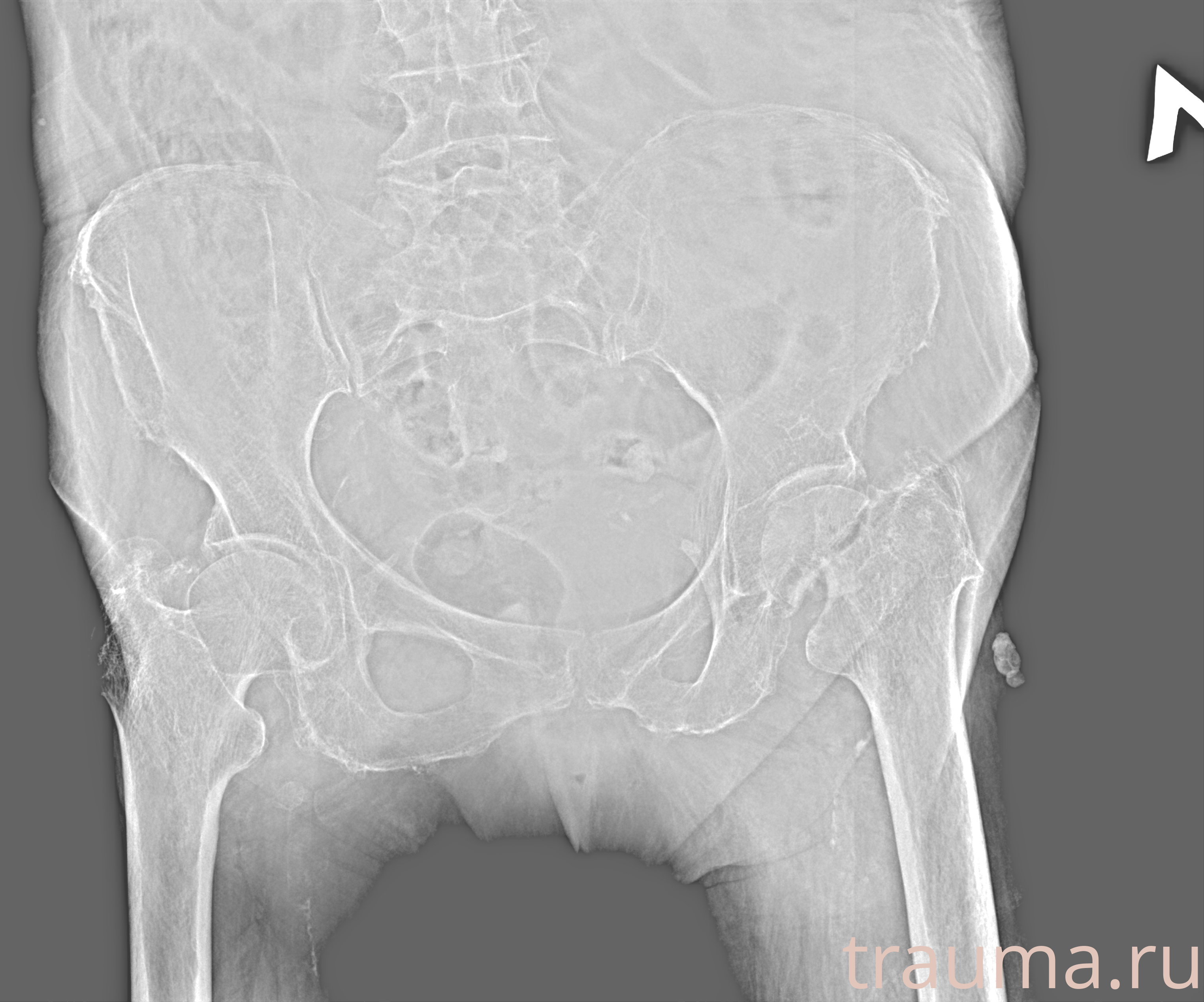 Рентген на дому: по вашему адресу приезжает врач-рентгенолог, травматолог-ортопед с мобильным рентгеновским аппаратом, проводит диагностику травмы или заболевания, делает необходимые рентгенограммы, дает рекомендации по дальнейшему лечению. Получить качественные снимки в домашних условиях возможно благодаря уникальной методике, разработанной МосРентген Центром для института  Склифосовского