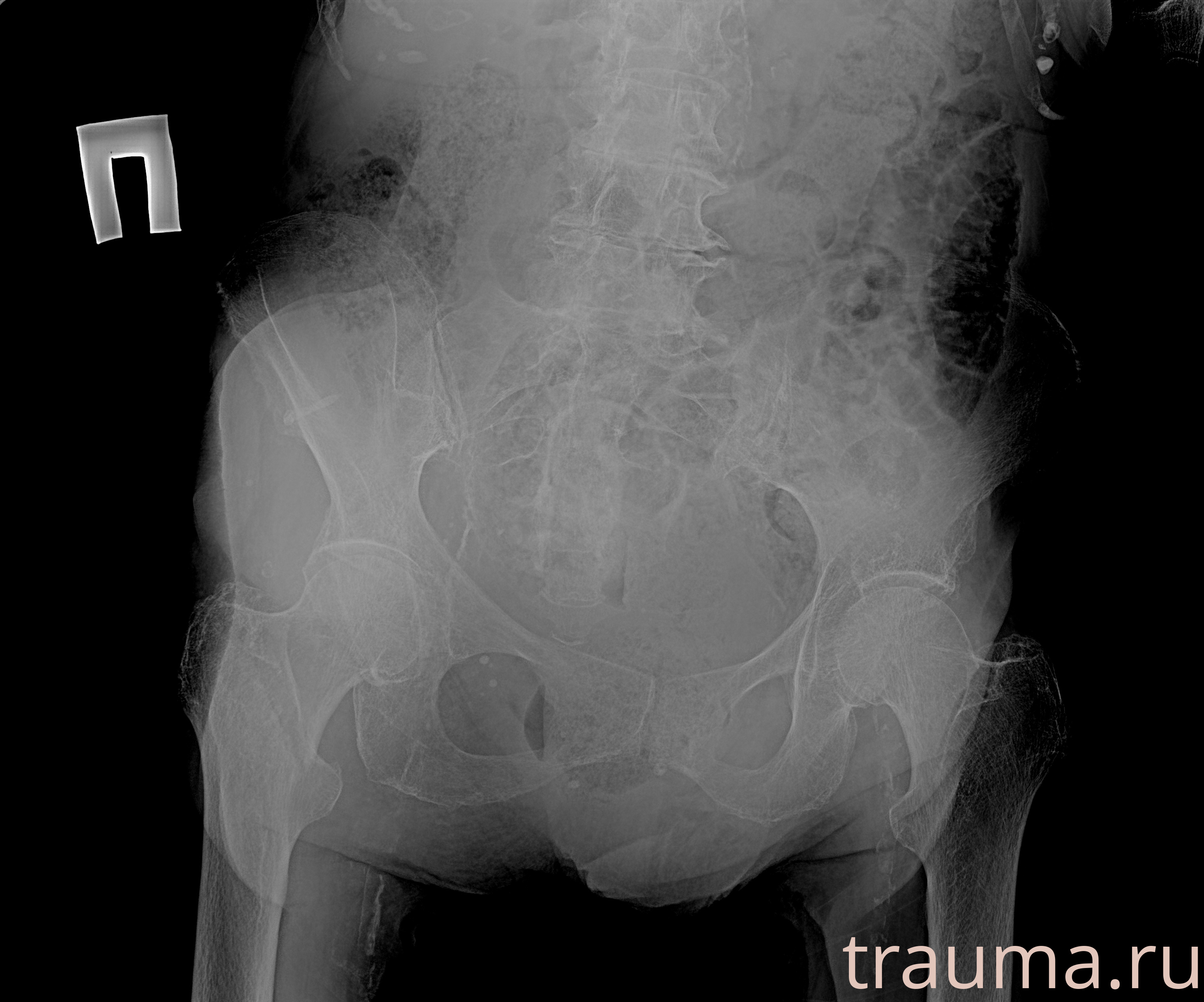 Рентген на дому: по вашему адресу приезжает врач-рентгенолог, травматолог-ортопед с мобильным рентгеновским аппаратом, проводит диагностику травмы или заболевания, делает необходимые рентгенограммы, дает рекомендации по дальнейшему лечению. Получить качественные снимки в домашних условиях возможно благодаря уникальной методике, разработанной МосРентген Центром для института  Склифосовского