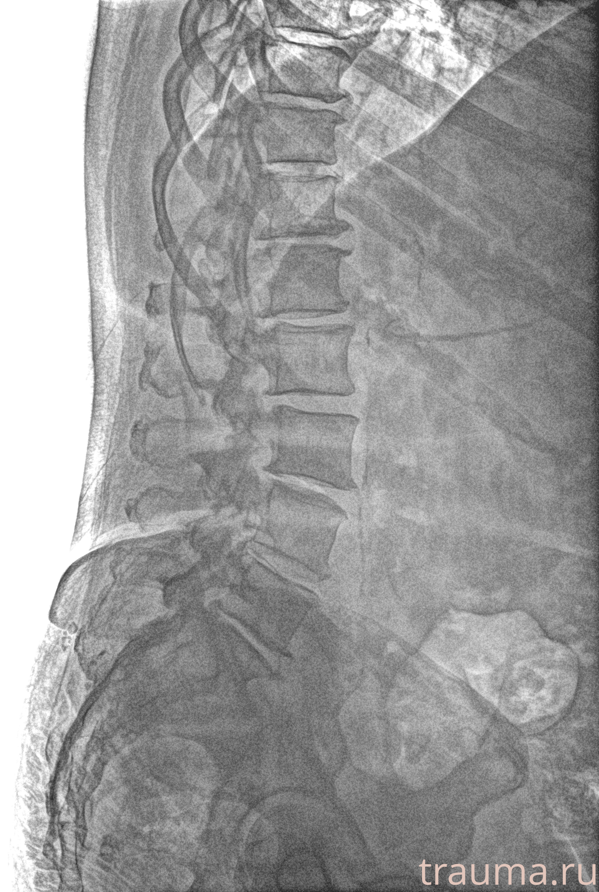 Рентген на дому: по вашему адресу приезжает врач-рентгенолог, травматолог-ортопед с мобильным рентгеновским аппаратом, проводит диагностику травмы или заболевания, делает необходимые рентгенограммы, дает рекомендации по дальнейшему лечению. Получить качественные снимки в домашних условиях возможно благодаря уникальной методике, разработанной МосРентген Центром для института  Склифосовского