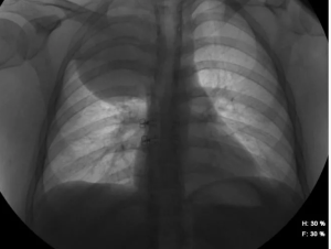 Нейрофиброма легких