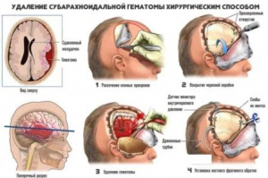 Эндоскопическое удаление травматических внутримозговых гематом в остром периоде
Эндоскопическое удаление травматических внутримозговых гематом в остром периоде