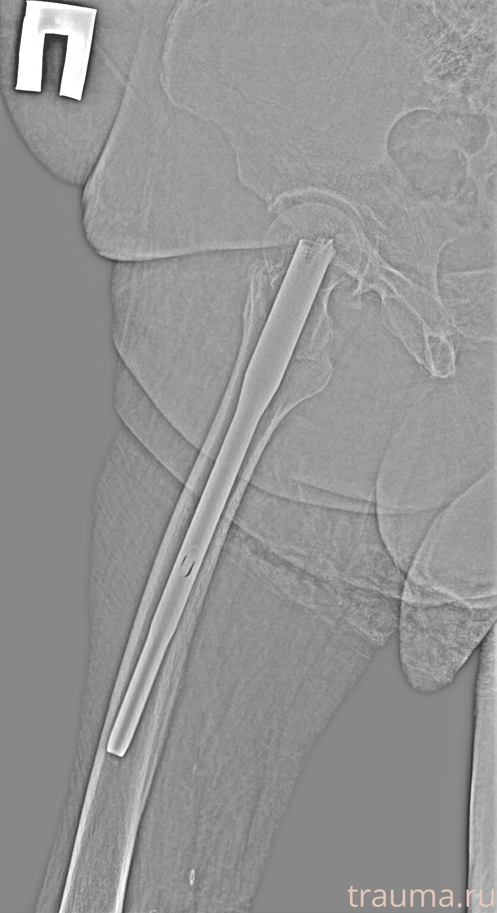 Рентген на дому: по вашему адресу приезжает врач-рентгенолог, травматолог-ортопед с мобильным рентгеновским аппаратом, проводит диагностику травмы или заболевания, делает необходимые рентгенограммы, дает рекомендации по дальнейшему лечению. Получить качественные снимки в домашних условиях возможно благодаря уникальной методике, разработанной МосРентген Центром для института  Склифосовского