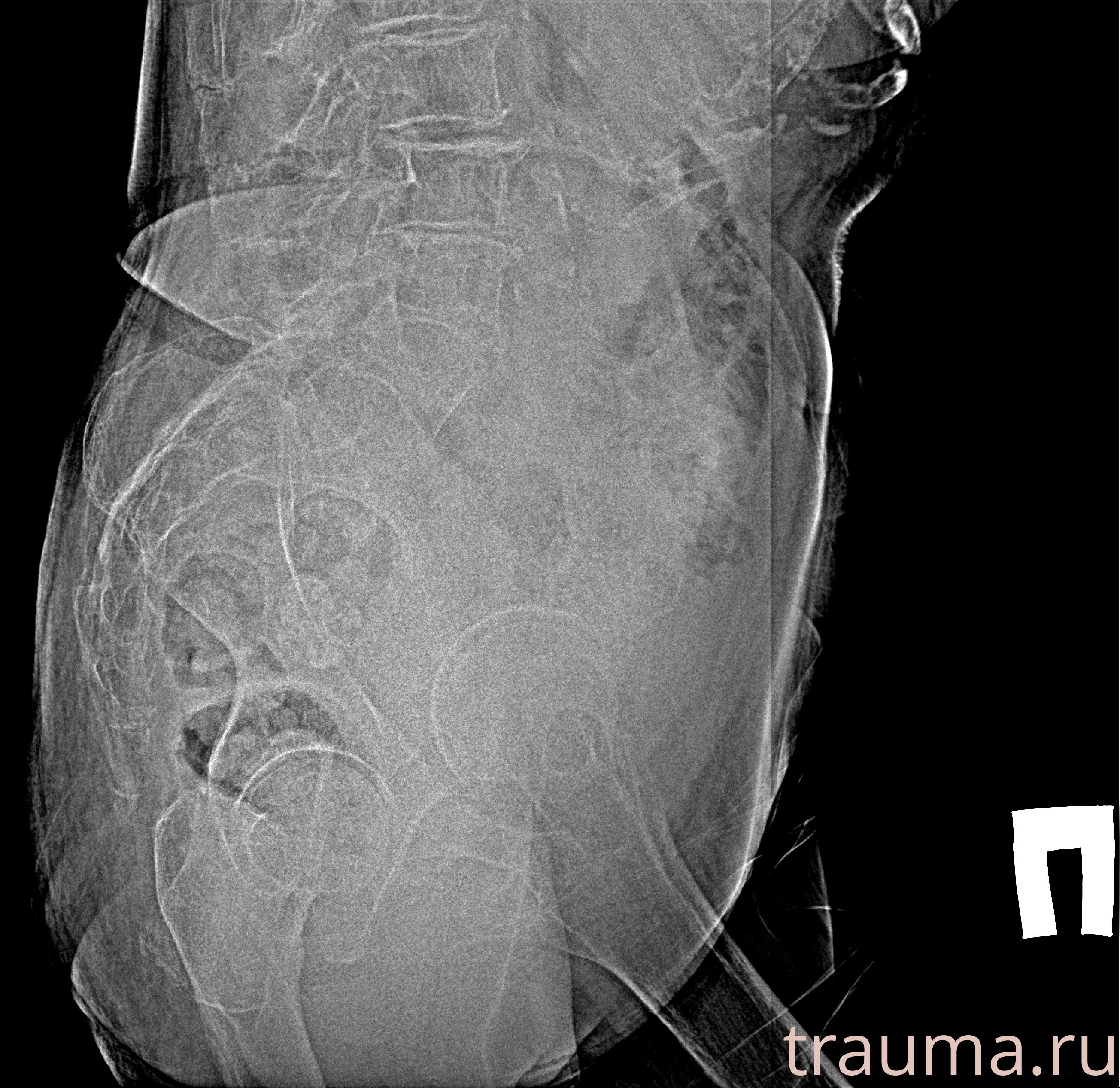 Рентген на дому: по вашему адресу приезжает врач-рентгенолог, травматолог-ортопед с мобильным рентгеновским аппаратом, проводит диагностику травмы или заболевания, делает необходимые рентгенограммы, дает рекомендации по дальнейшему лечению. Получить качественные снимки в домашних условиях возможно благодаря уникальной методике, разработанной МосРентген Центром для института  Склифосовского