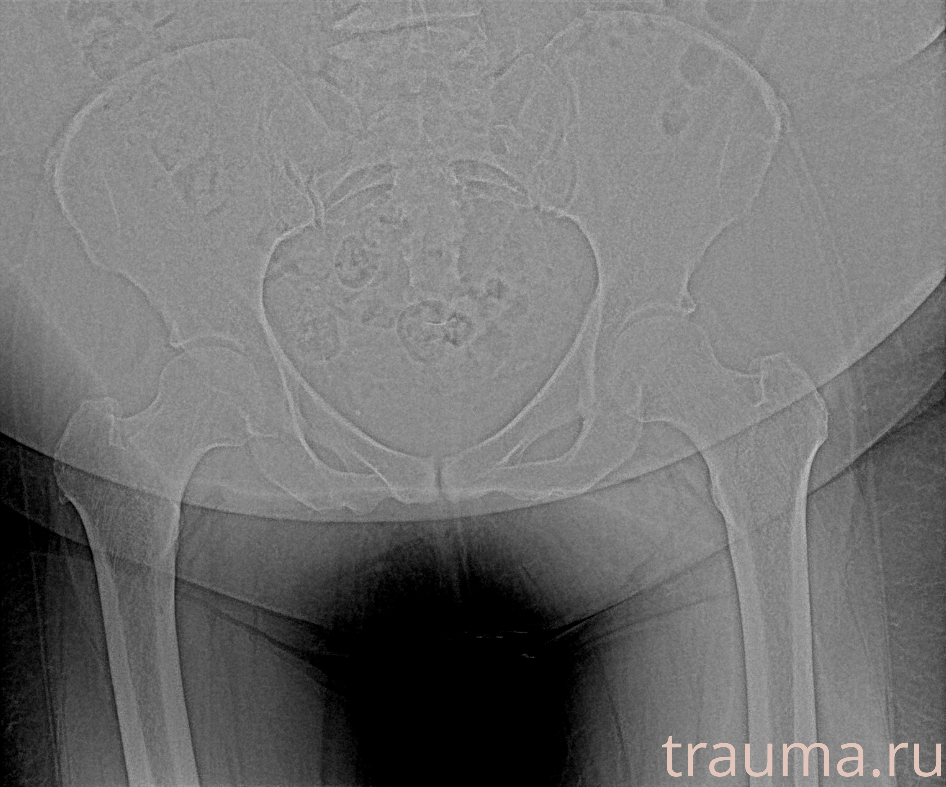 Рентген на дому: по вашему адресу приезжает врач-рентгенолог, травматолог-ортопед с мобильным рентгеновским аппаратом, проводит диагностику травмы или заболевания, делает необходимые рентгенограммы, дает рекомендации по дальнейшему лечению. Получить качественные снимки в домашних условиях возможно благодаря уникальной методике, разработанной МосРентген Центром для института  Склифосовского
