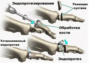 Цифровое моделирование критических состояний эндопротезирования пястно-фалангового сустава Цифровое моделирование критических состояний эндопротезирования пястно-фалангового сустава