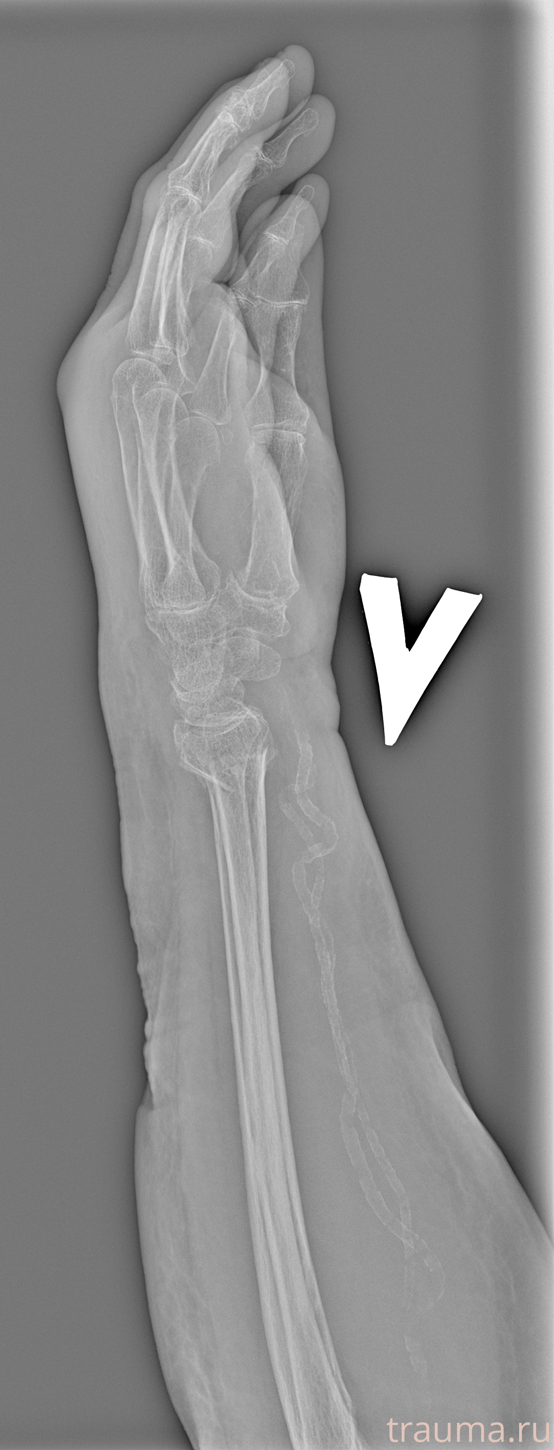 Рентген на дому: по вашему адресу приезжает врач-рентгенолог, травматолог-ортопед с мобильным рентгеновским аппаратом, проводит диагностику травмы или заболевания, делает необходимые рентгенограммы, дает рекомендации по дальнейшему лечению. Получить качественные снимки в домашних условиях возможно благодаря уникальной методике, разработанной МосРентген Центром для института  Склифосовского