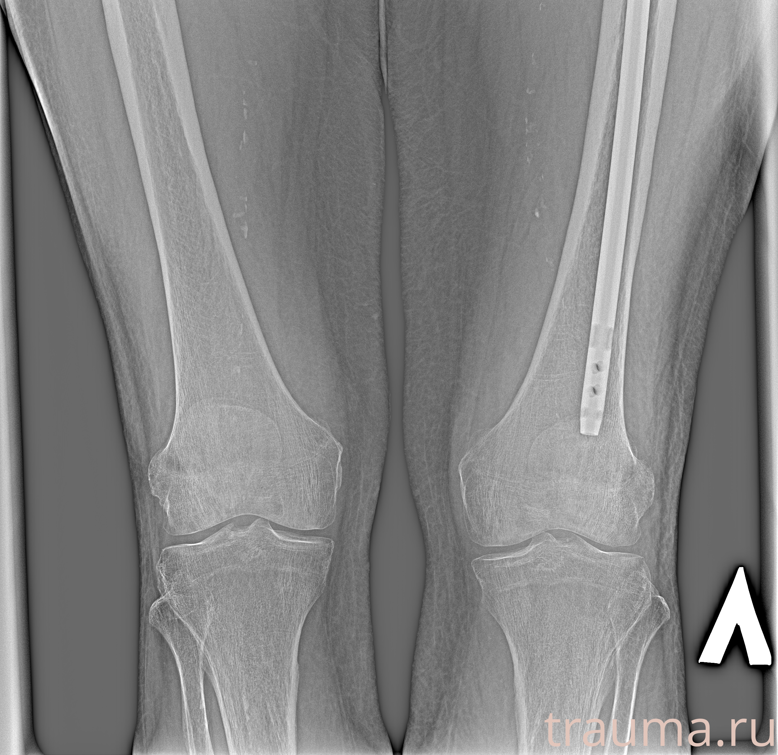 Рентген на дому: по вашему адресу приезжает врач-рентгенолог, травматолог-ортопед с мобильным рентгеновским аппаратом, проводит диагностику травмы или заболевания, делает необходимые рентгенограммы, дает рекомендации по дальнейшему лечению. Получить качественные снимки в домашних условиях возможно благодаря уникальной методике, разработанной МосРентген Центром для института  Склифосовского
