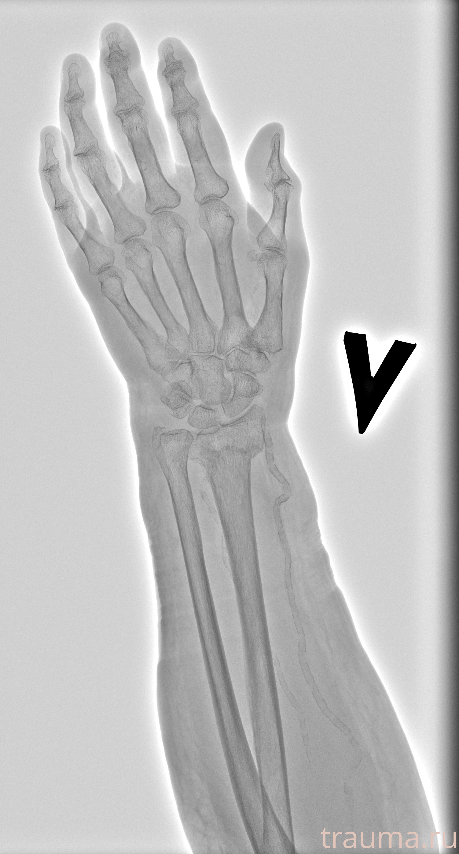 Рентген на дому: по вашему адресу приезжает врач-рентгенолог, травматолог-ортопед с мобильным рентгеновским аппаратом, проводит диагностику травмы или заболевания, делает необходимые рентгенограммы, дает рекомендации по дальнейшему лечению. Получить качественные снимки в домашних условиях возможно благодаря уникальной методике, разработанной МосРентген Центром для института  Склифосовского