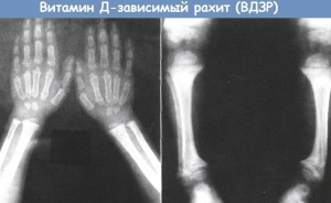 МРТ и КТ визуализация последствий рахита и витаминD-резистентного рахита
МРТ и КТ визуализация последствий рахита и витаминD-резистентного рахита