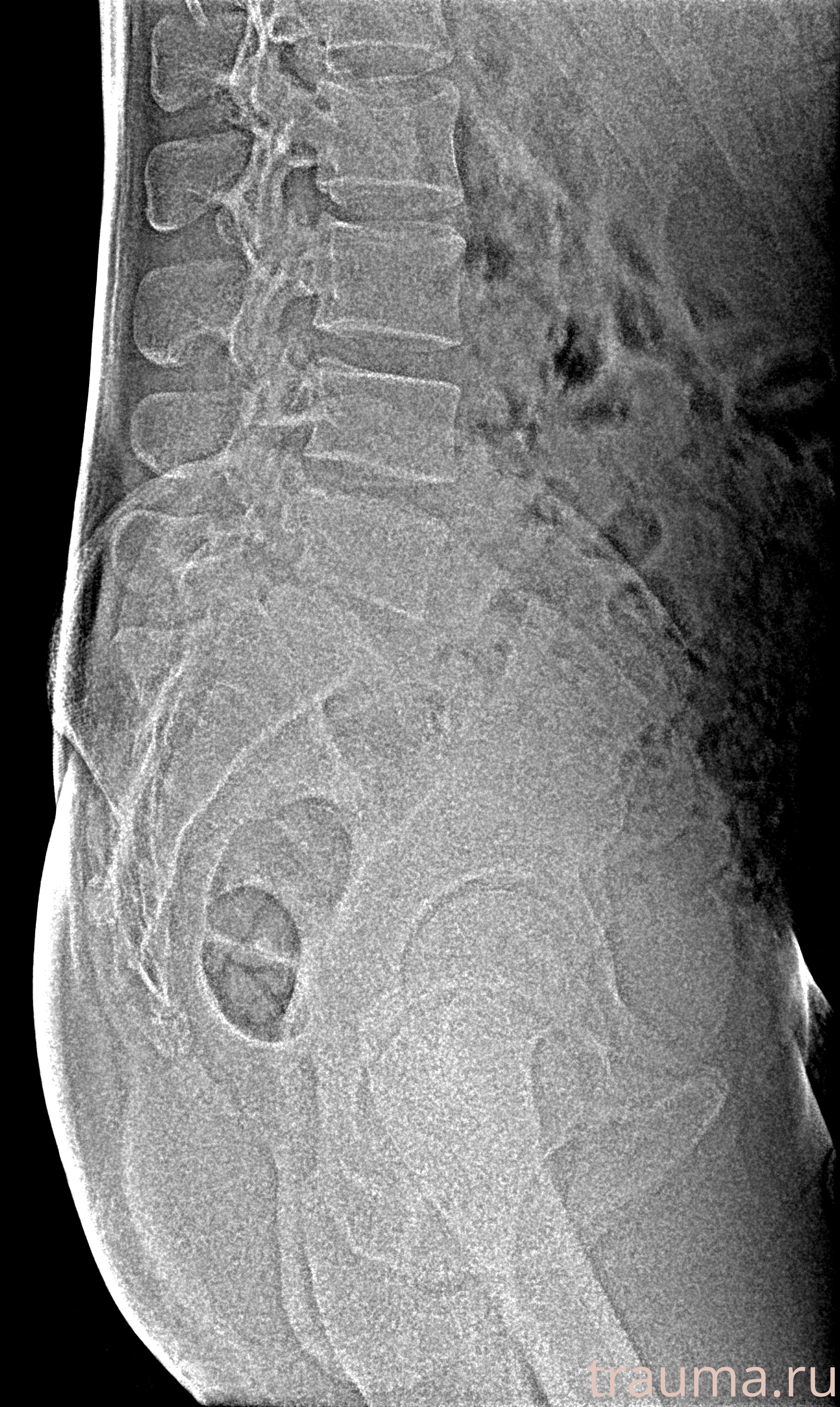 Рентген на дому: по вашему адресу приезжает врач-рентгенолог, травматолог-ортопед с мобильным рентгеновским аппаратом, проводит диагностику травмы или заболевания, делает необходимые рентгенограммы, дает рекомендации по дальнейшему лечению. Получить качественные снимки в домашних условиях возможно благодаря уникальной методике, разработанной МосРентген Центром для института  Склифосовского