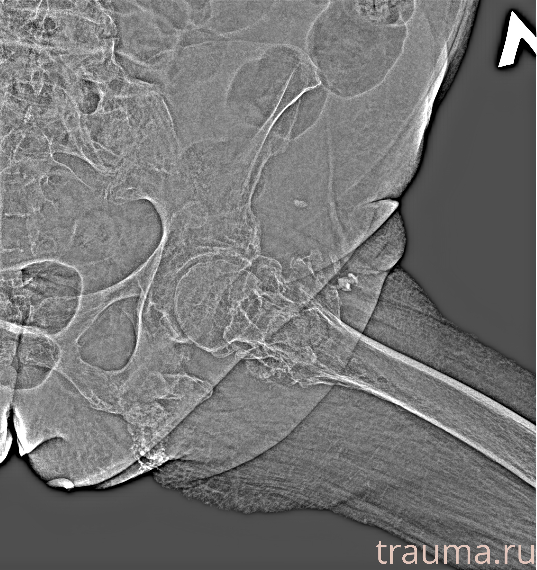 Рентген на дому: по вашему адресу приезжает врач-рентгенолог, травматолог-ортопед с мобильным рентгеновским аппаратом, проводит диагностику травмы или заболевания, делает необходимые рентгенограммы, дает рекомендации по дальнейшему лечению. Получить качественные снимки в домашних условиях возможно благодаря уникальной методике, разработанной МосРентген Центром для института  Склифосовского