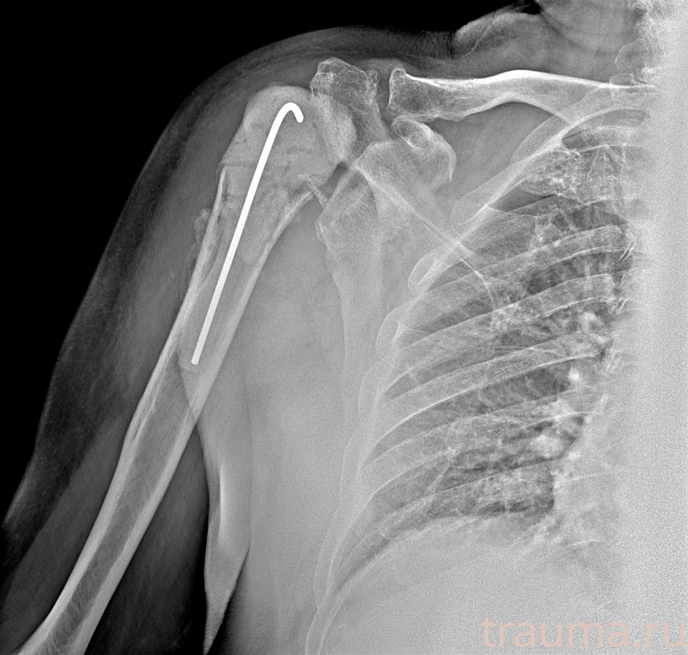 Рентген на дому: по вашему адресу приезжает врач-рентгенолог, травматолог-ортопед с мобильным рентгеновским аппаратом, проводит диагностику травмы или заболевания, делает необходимые рентгенограммы, дает рекомендации по дальнейшему лечению. Получить качественные снимки в домашних условиях возможно благодаря уникальной методике, разработанной МосРентген Центром для института  Склифосовского