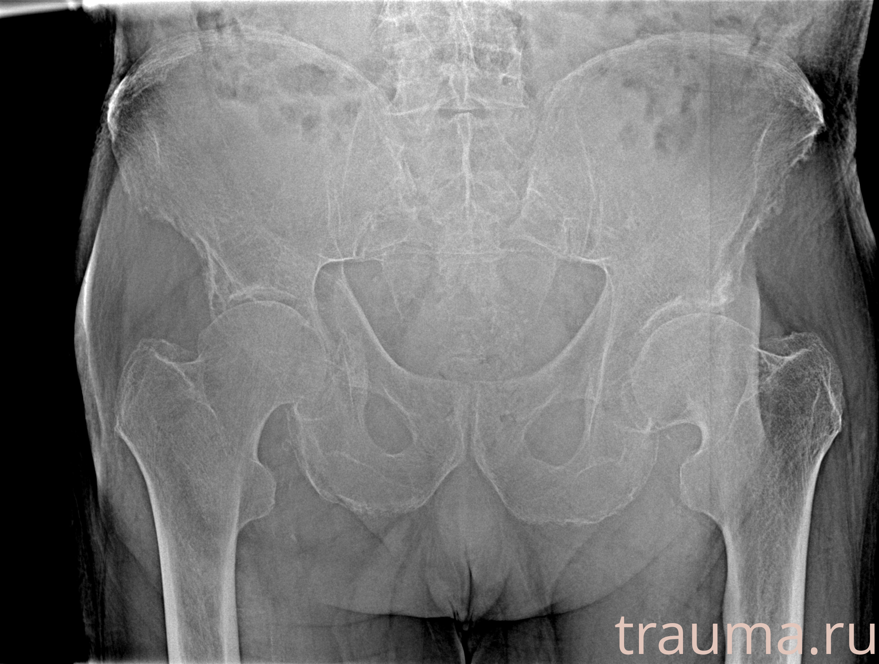 Рентген на дому: по вашему адресу приезжает врач-рентгенолог, травматолог-ортопед с мобильным рентгеновским аппаратом, проводит диагностику травмы или заболевания, делает необходимые рентгенограммы, дает рекомендации по дальнейшему лечению. Получить качественные снимки в домашних условиях возможно благодаря уникальной методике, разработанной МосРентген Центром для института  Склифосовского