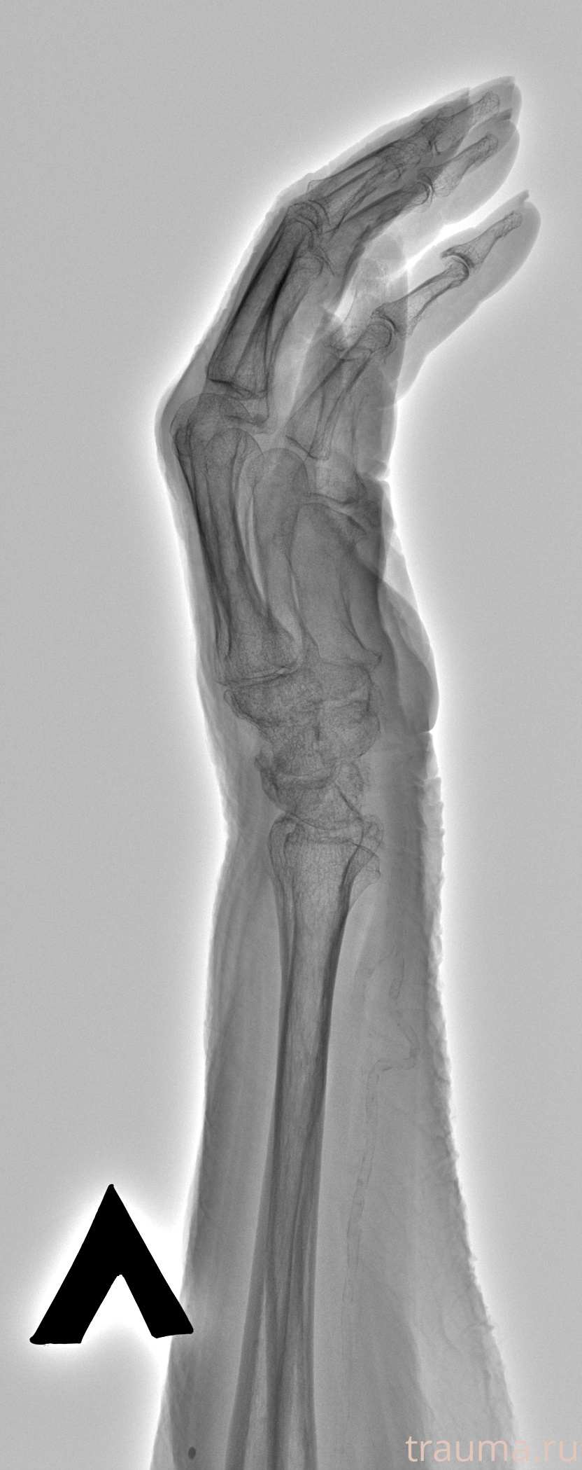 Рентген на дому: по вашему адресу приезжает врач-рентгенолог, травматолог-ортопед с мобильным рентгеновским аппаратом, проводит диагностику травмы или заболевания, делает необходимые рентгенограммы, дает рекомендации по дальнейшему лечению. Получить качественные снимки в домашних условиях возможно благодаря уникальной методике, разработанной МосРентген Центром для института  Склифосовского