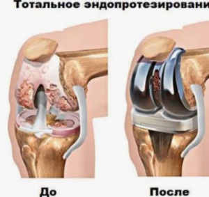 Клинико-функциональный и нейропсихологический статус пациентов, поступивших на эндопротезирование суставов
Клинико-функциональный и нейропсихологический статус пациентов, поступивших на эндопротезирование суставов