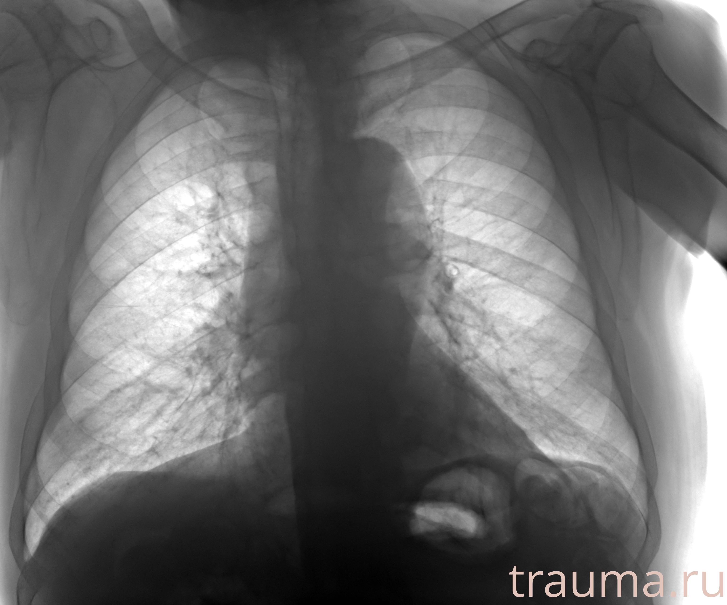 Рентген на дому: по вашему адресу приезжает врач-рентгенолог, травматолог-ортопед с мобильным рентгеновским аппаратом, проводит диагностику травмы или заболевания, делает необходимые рентгенограммы, дает рекомендации по дальнейшему лечению. Получить качественные снимки в домашних условиях возможно благодаря уникальной методике, разработанной МосРентген Центром для института  Склифосовского