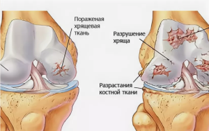 Анализ регенерации гиалинового хряща коленого сустава после лазерной обработки участков хондропатии различной степени
Анализ регенерации гиалинового хряща коленого сустава после лазерной обработки участков хондропатии различной степени
