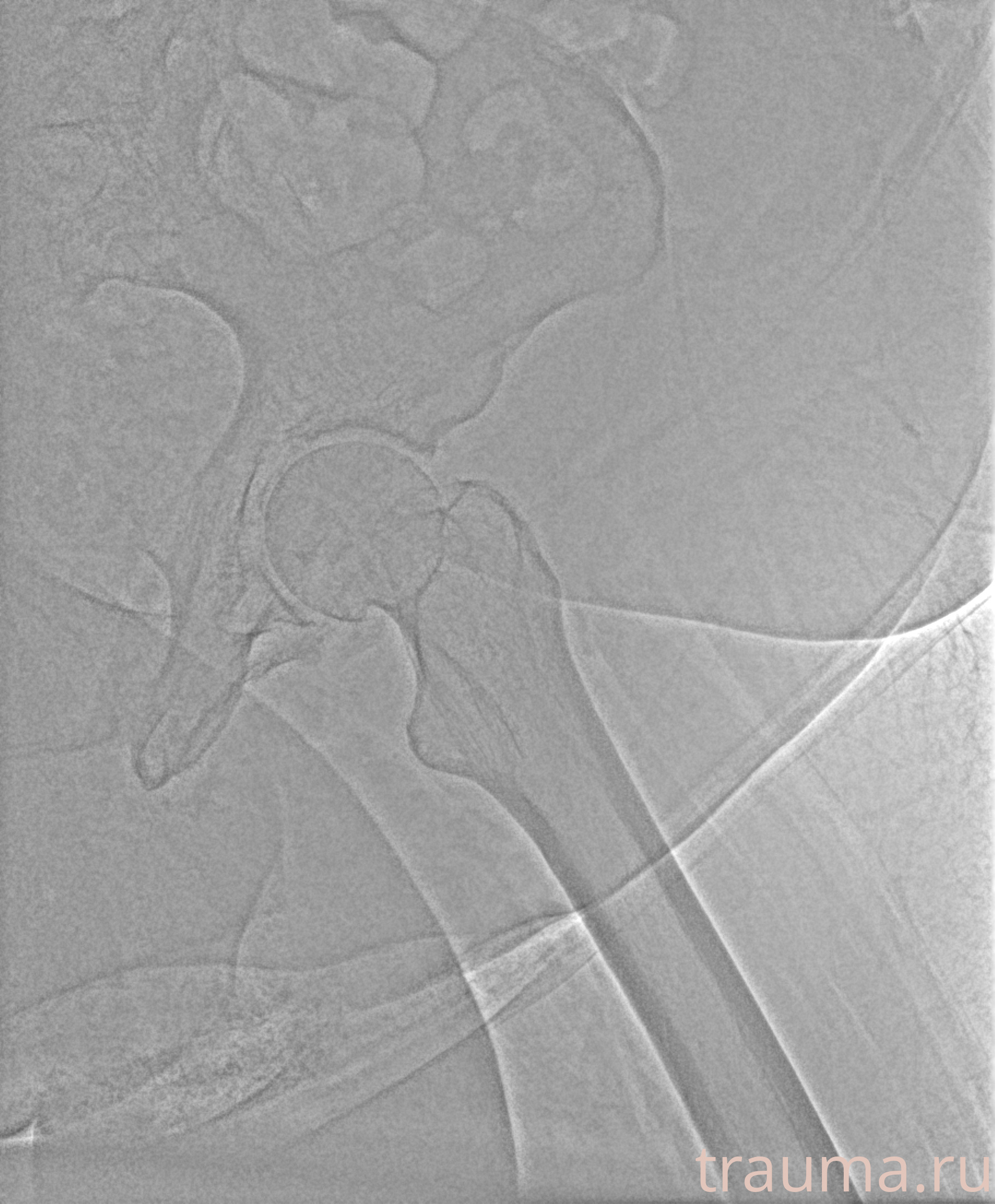 Рентген на дому: по вашему адресу приезжает врач-рентгенолог, травматолог-ортопед с мобильным рентгеновским аппаратом, проводит диагностику травмы или заболевания, делает необходимые рентгенограммы, дает рекомендации по дальнейшему лечению. Получить качественные снимки в домашних условиях возможно благодаря уникальной методике, разработанной МосРентген Центром для института  Склифосовского