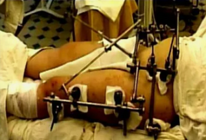 Стратегии и тактики ранней хирургической помощи пострадавшим с политравмами при переломах длинных костей: методология объективного выбора хирургической (сообщение 2)