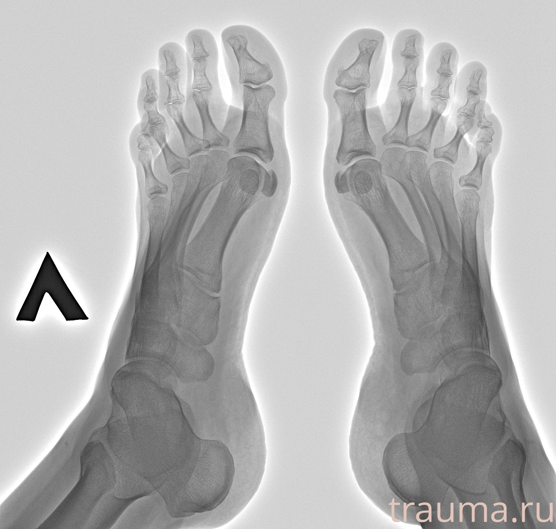 Рентген на дому: по вашему адресу приезжает врач-рентгенолог, травматолог-ортопед с мобильным рентгеновским аппаратом, проводит диагностику травмы или заболевания, делает необходимые рентгенограммы, дает рекомендации по дальнейшему лечению. Получить качественные снимки в домашних условиях возможно благодаря уникальной методике, разработанной МосРентген Центром для института  Склифосовского