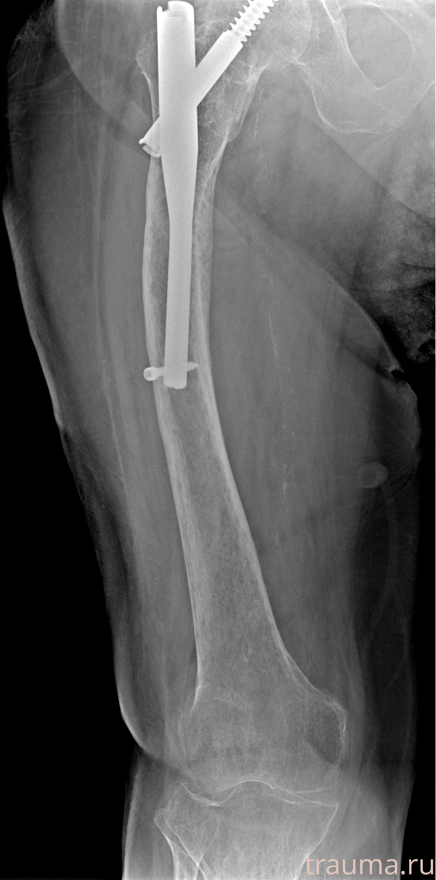 Рентген на дому: по вашему адресу приезжает врач-рентгенолог, травматолог-ортопед с мобильным рентгеновским аппаратом, проводит диагностику травмы или заболевания, делает необходимые рентгенограммы, дает рекомендации по дальнейшему лечению. Получить качественные снимки в домашних условиях возможно благодаря уникальной методике, разработанной МосРентген Центром для института  Склифосовского