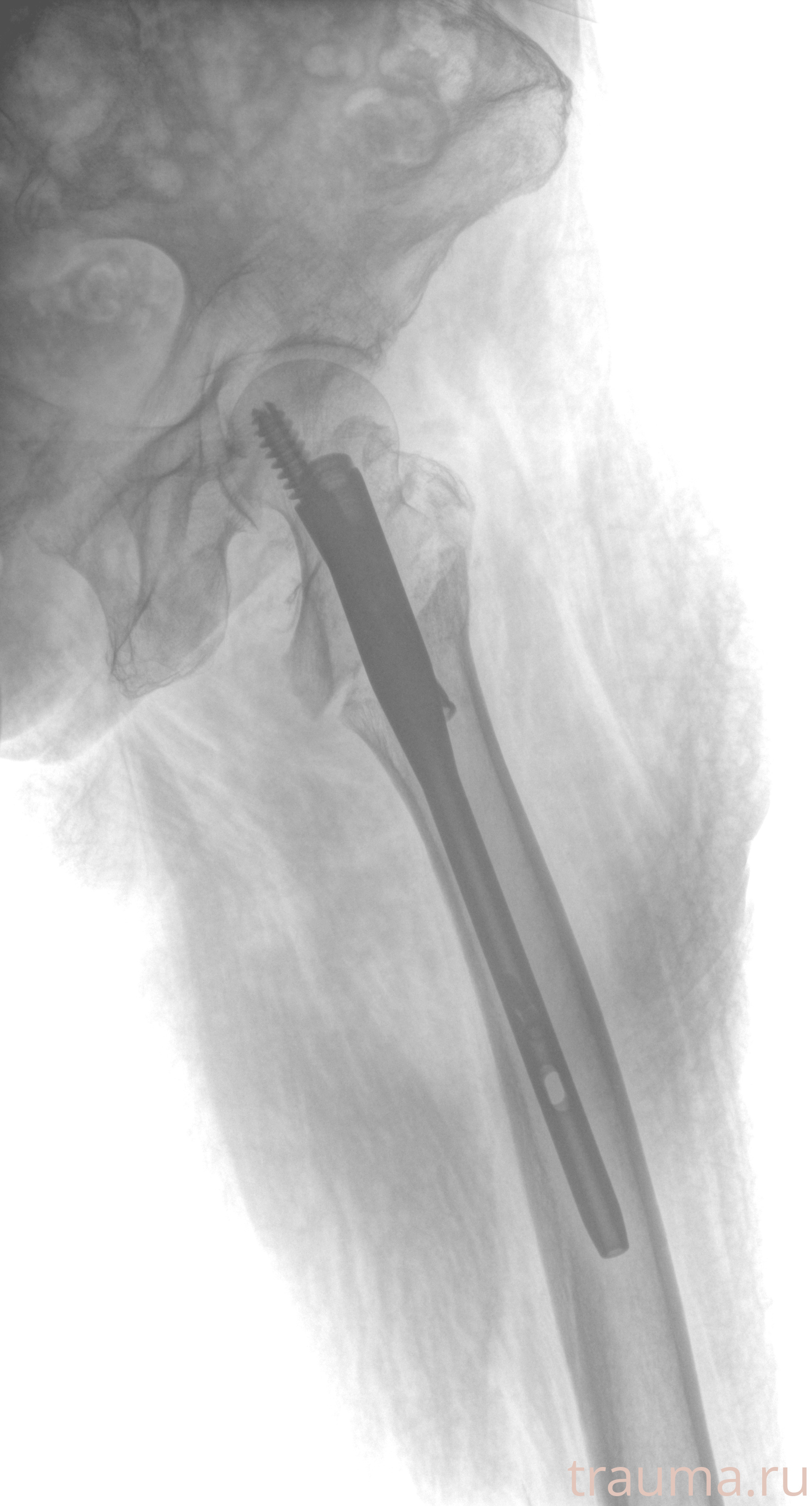 Рентген на дому: по вашему адресу приезжает врач-рентгенолог, травматолог-ортопед с мобильным рентгеновским аппаратом, проводит диагностику травмы или заболевания, делает необходимые рентгенограммы, дает рекомендации по дальнейшему лечению. Получить качественные снимки в домашних условиях возможно благодаря уникальной методике, разработанной МосРентген Центром для института  Склифосовского