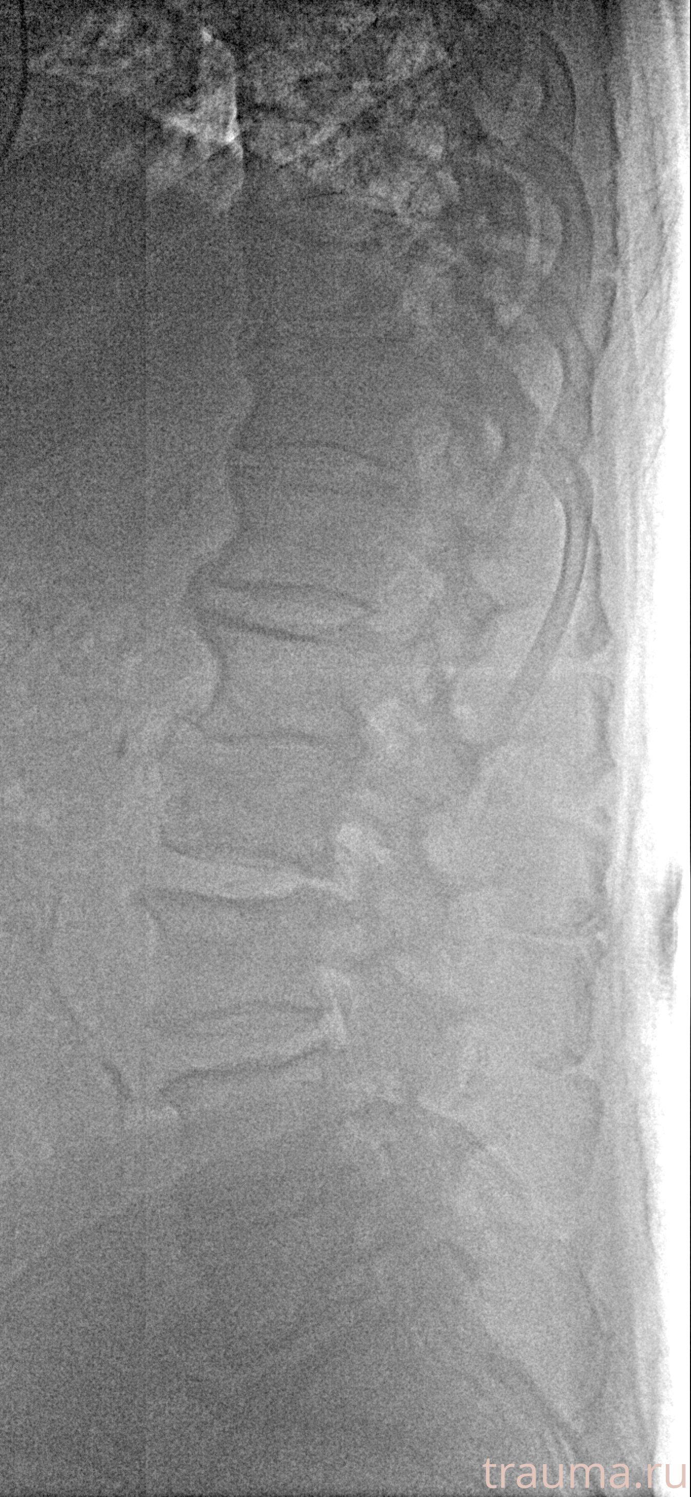 Рентген на дому: по вашему адресу приезжает врач-рентгенолог, травматолог-ортопед с мобильным рентгеновским аппаратом, проводит диагностику травмы или заболевания, делает необходимые рентгенограммы, дает рекомендации по дальнейшему лечению. Получить качественные снимки в домашних условиях возможно благодаря уникальной методике, разработанной МосРентген Центром для института  Склифосовского