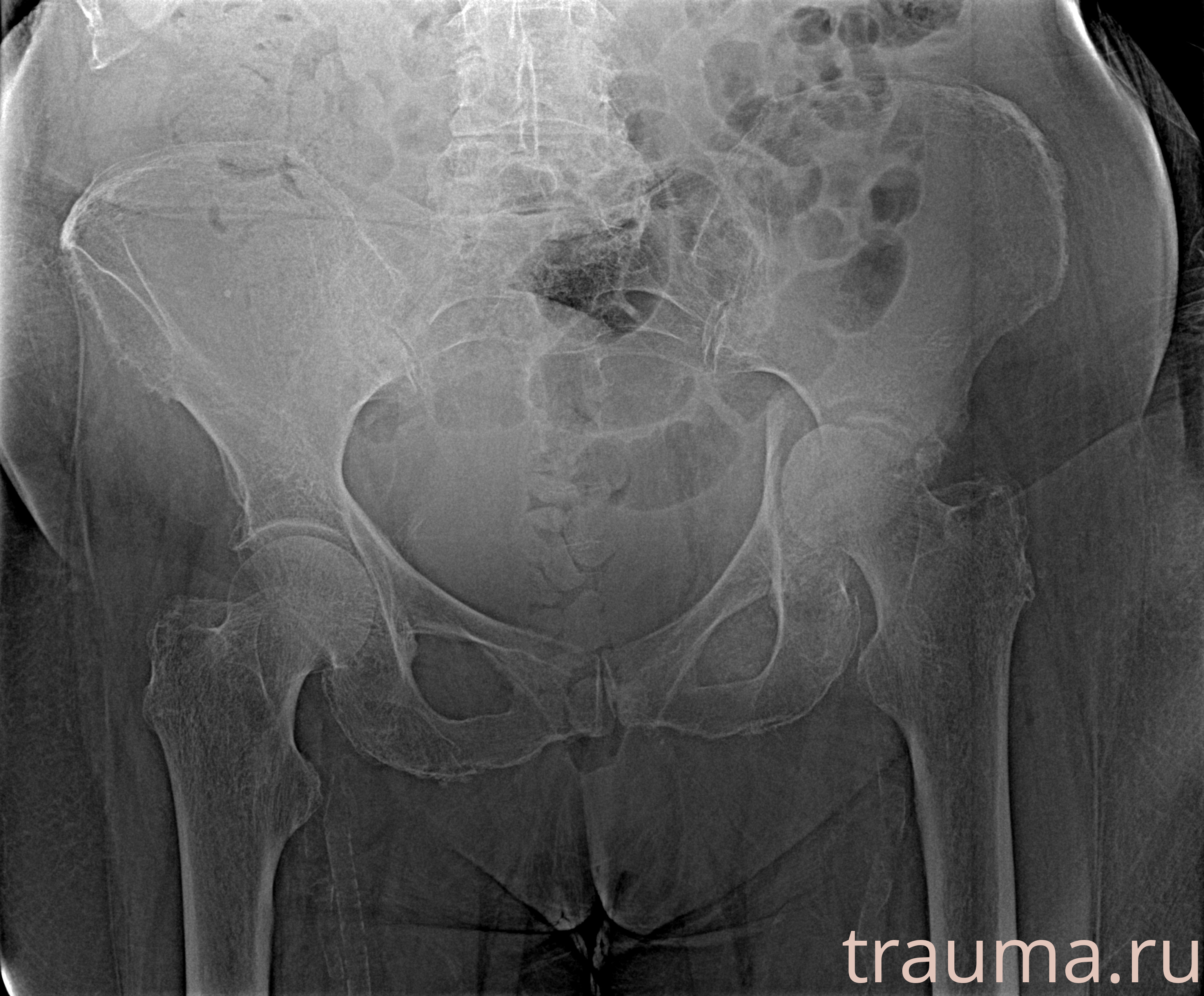 Рентген на дому: по вашему адресу приезжает врач-рентгенолог, травматолог-ортопед с мобильным рентгеновским аппаратом, проводит диагностику травмы или заболевания, делает необходимые рентгенограммы, дает рекомендации по дальнейшему лечению. Получить качественные снимки в домашних условиях возможно благодаря уникальной методике, разработанной МосРентген Центром для института  Склифосовского