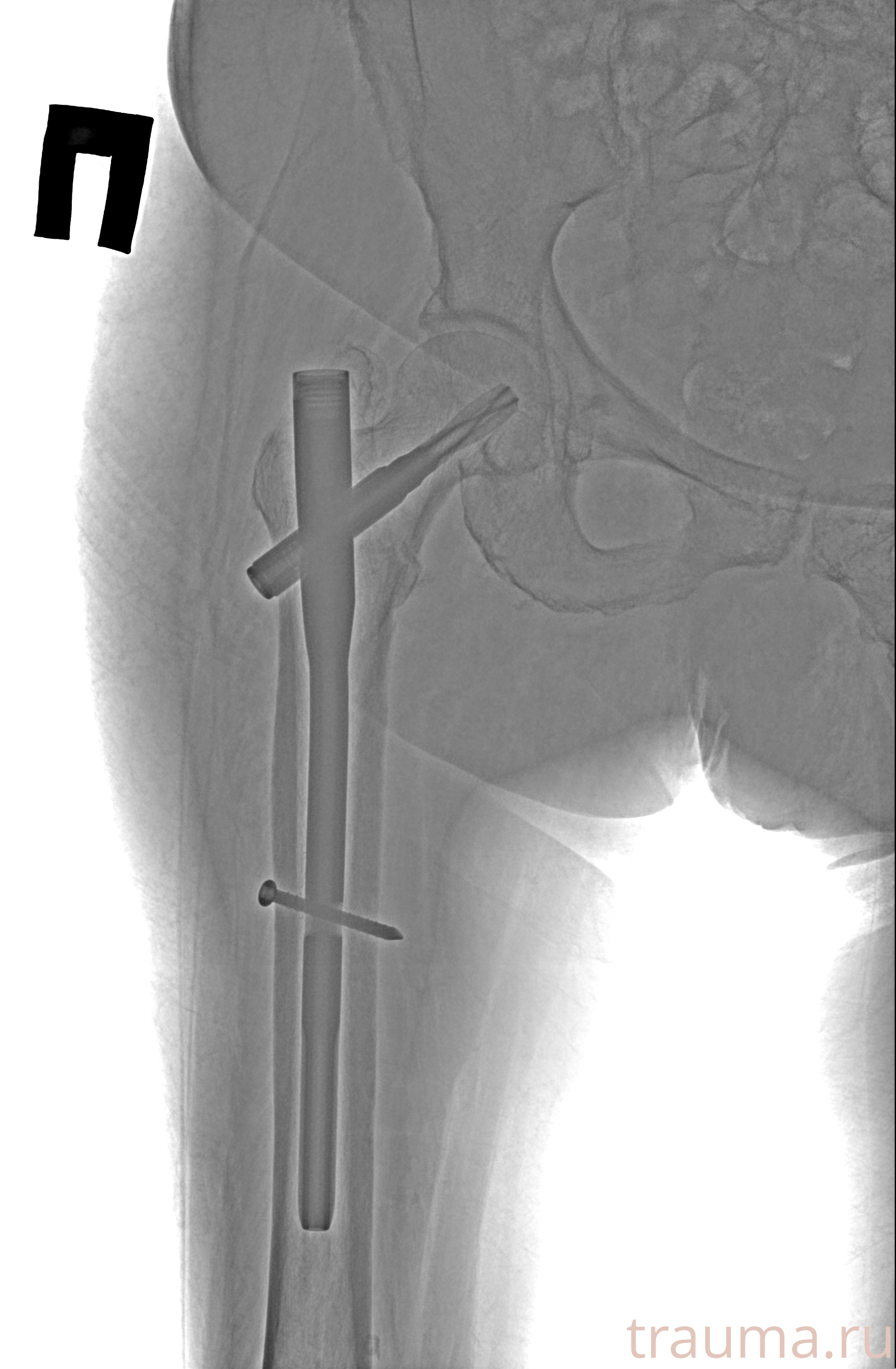 Рентген на дому: по вашему адресу приезжает врач-рентгенолог, травматолог-ортопед с мобильным рентгеновским аппаратом, проводит диагностику травмы или заболевания, делает необходимые рентгенограммы, дает рекомендации по дальнейшему лечению. Получить качественные снимки в домашних условиях возможно благодаря уникальной методике, разработанной МосРентген Центром для института  Склифосовского