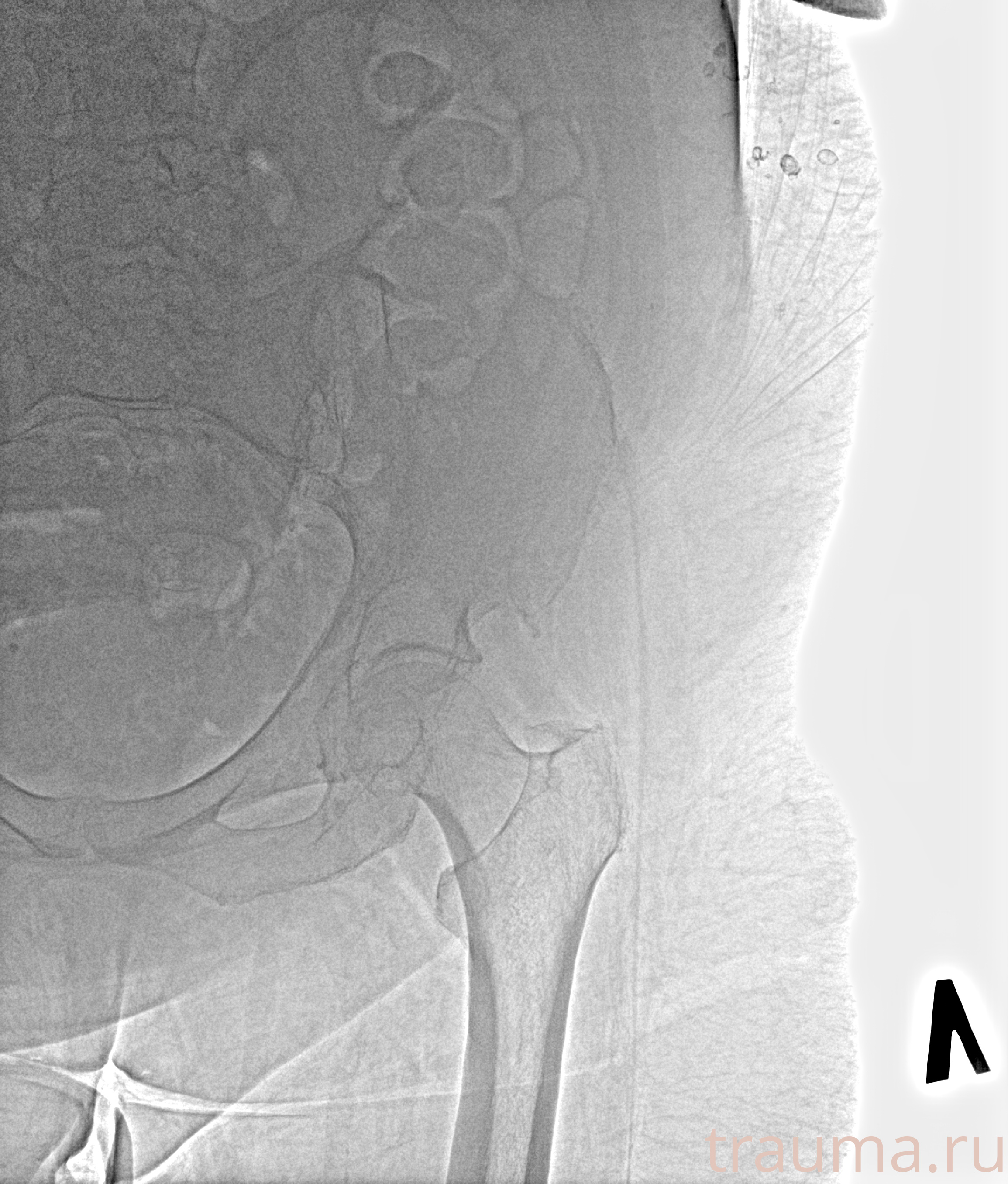 Рентген на дому: по вашему адресу приезжает врач-рентгенолог, травматолог-ортопед с мобильным рентгеновским аппаратом, проводит диагностику травмы или заболевания, делает необходимые рентгенограммы, дает рекомендации по дальнейшему лечению. Получить качественные снимки в домашних условиях возможно благодаря уникальной методике, разработанной МосРентген Центром для института  Склифосовского