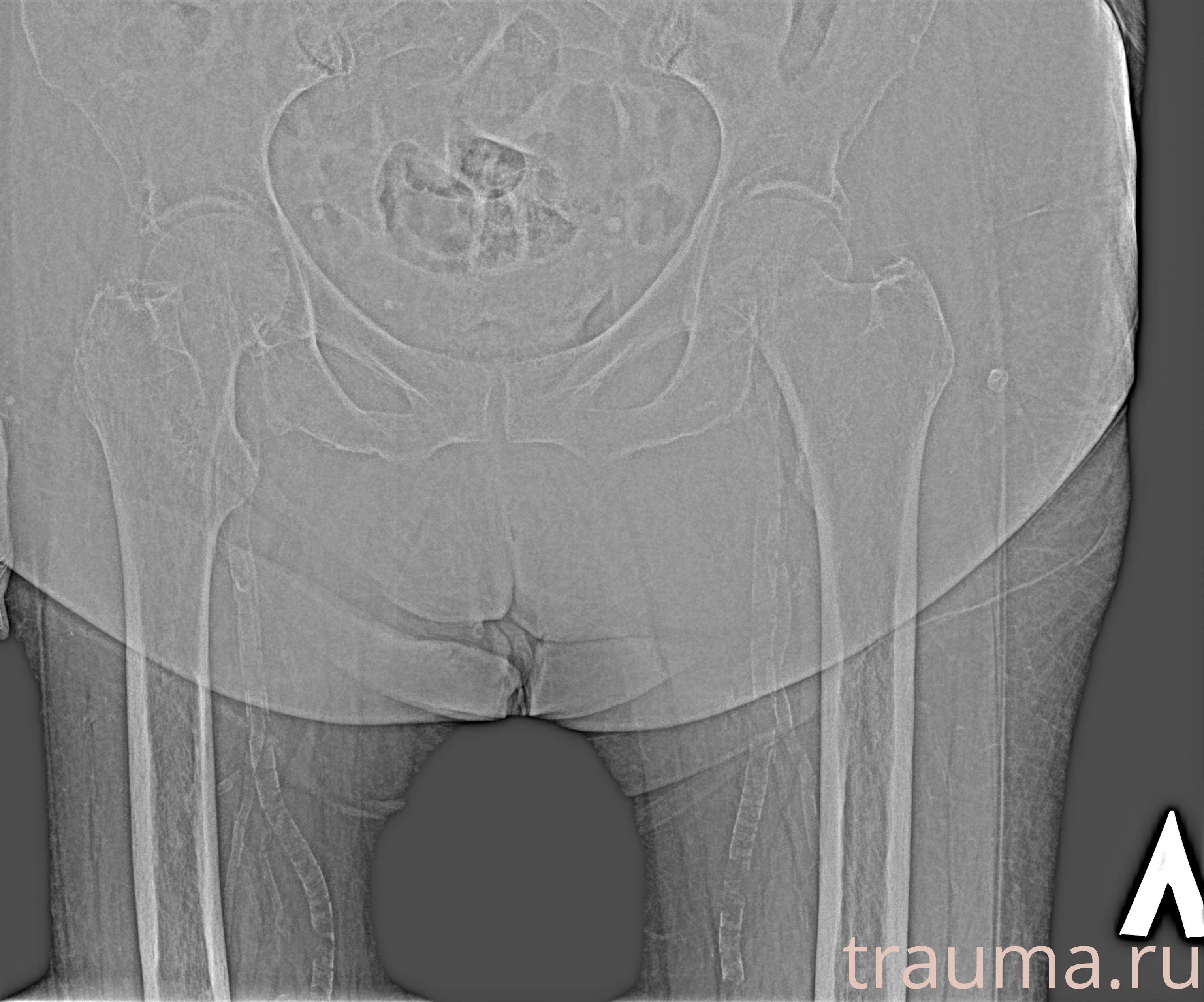 Рентген на дому: по вашему адресу приезжает врач-рентгенолог, травматолог-ортопед с мобильным рентгеновским аппаратом, проводит диагностику травмы или заболевания, делает необходимые рентгенограммы, дает рекомендации по дальнейшему лечению. Получить качественные снимки в домашних условиях возможно благодаря уникальной методике, разработанной МосРентген Центром для института  Склифосовского
