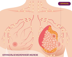 Рак молочной железы Рак молочной железы