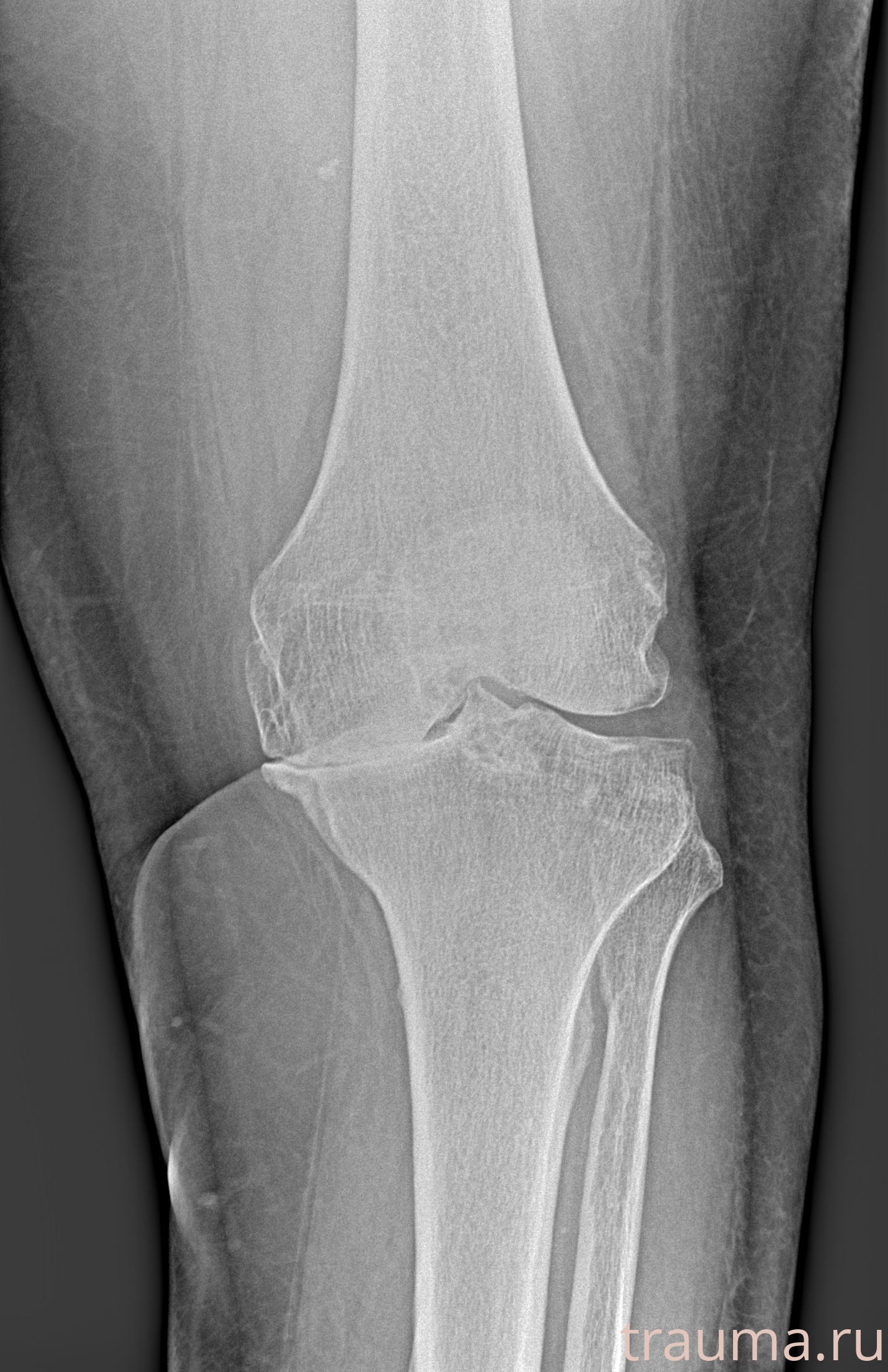 Рентген на дому: по вашему адресу приезжает врач-рентгенолог, травматолог-ортопед с мобильным рентгеновским аппаратом, проводит диагностику травмы или заболевания, делает необходимые рентгенограммы, дает рекомендации по дальнейшему лечению. Получить качественные снимки в домашних условиях возможно благодаря уникальной методике, разработанной МосРентген Центром для института  Склифосовского