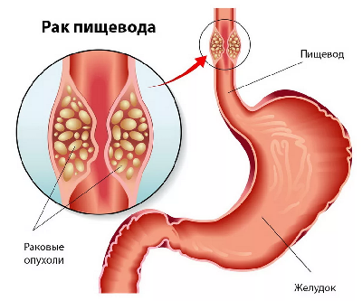 Большая опухолью пищевода Большая опухолью пищевода