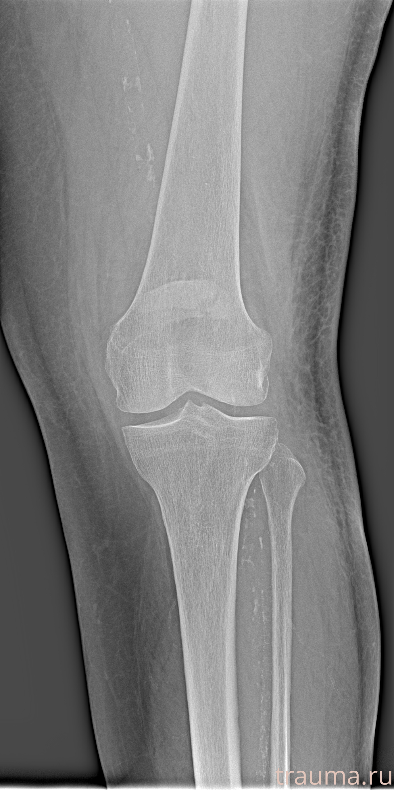 Рентген на дому: по вашему адресу приезжает врач-рентгенолог, травматолог-ортопед с мобильным рентгеновским аппаратом, проводит диагностику травмы или заболевания, делает необходимые рентгенограммы, дает рекомендации по дальнейшему лечению. Получить качественные снимки в домашних условиях возможно благодаря уникальной методике, разработанной МосРентген Центром для института  Склифосовского