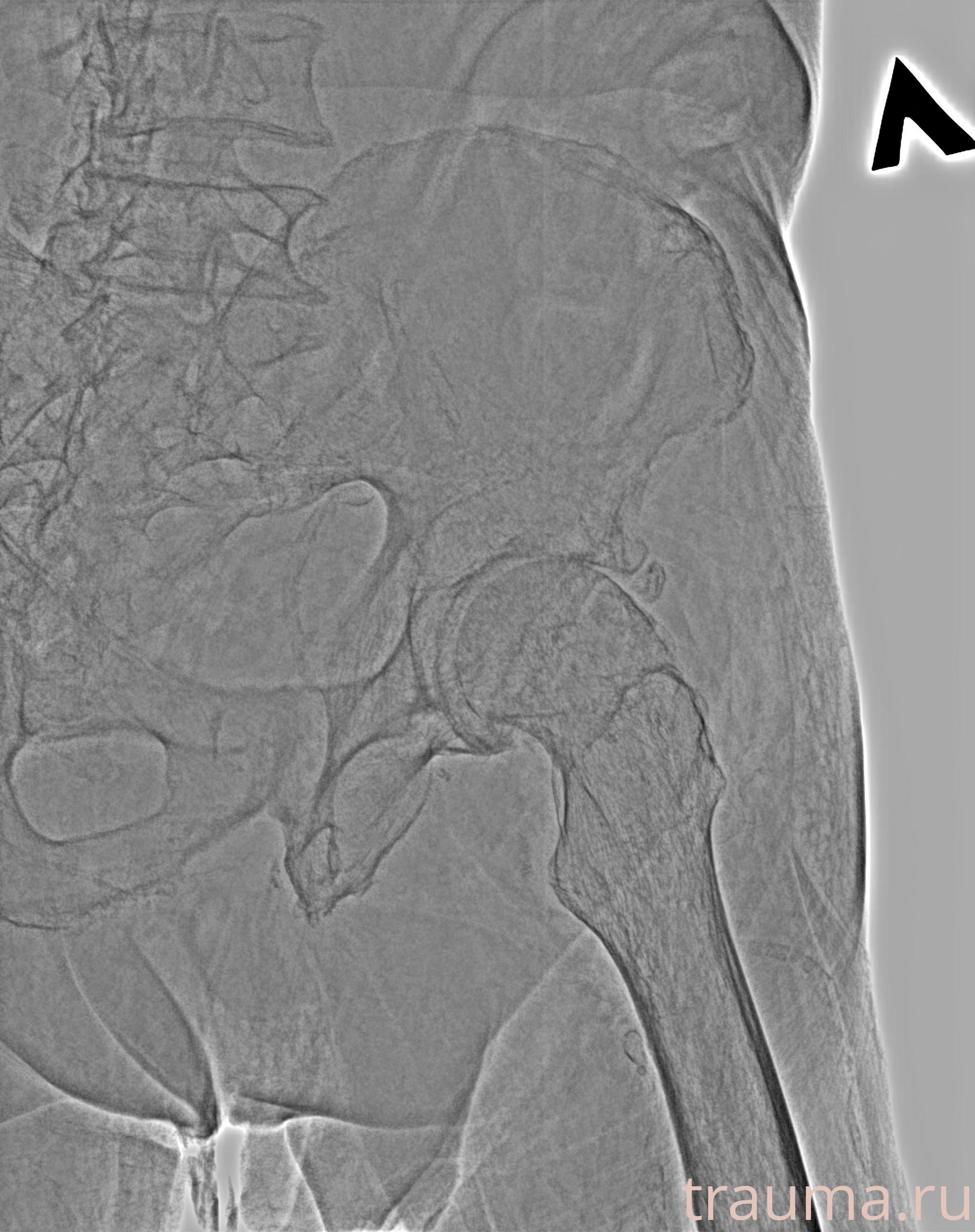 Рентген на дому: по вашему адресу приезжает врач-рентгенолог, травматолог-ортопед с мобильным рентгеновским аппаратом, проводит диагностику травмы или заболевания, делает необходимые рентгенограммы, дает рекомендации по дальнейшему лечению. Получить качественные снимки в домашних условиях возможно благодаря уникальной методике, разработанной МосРентген Центром для института  Склифосовского
