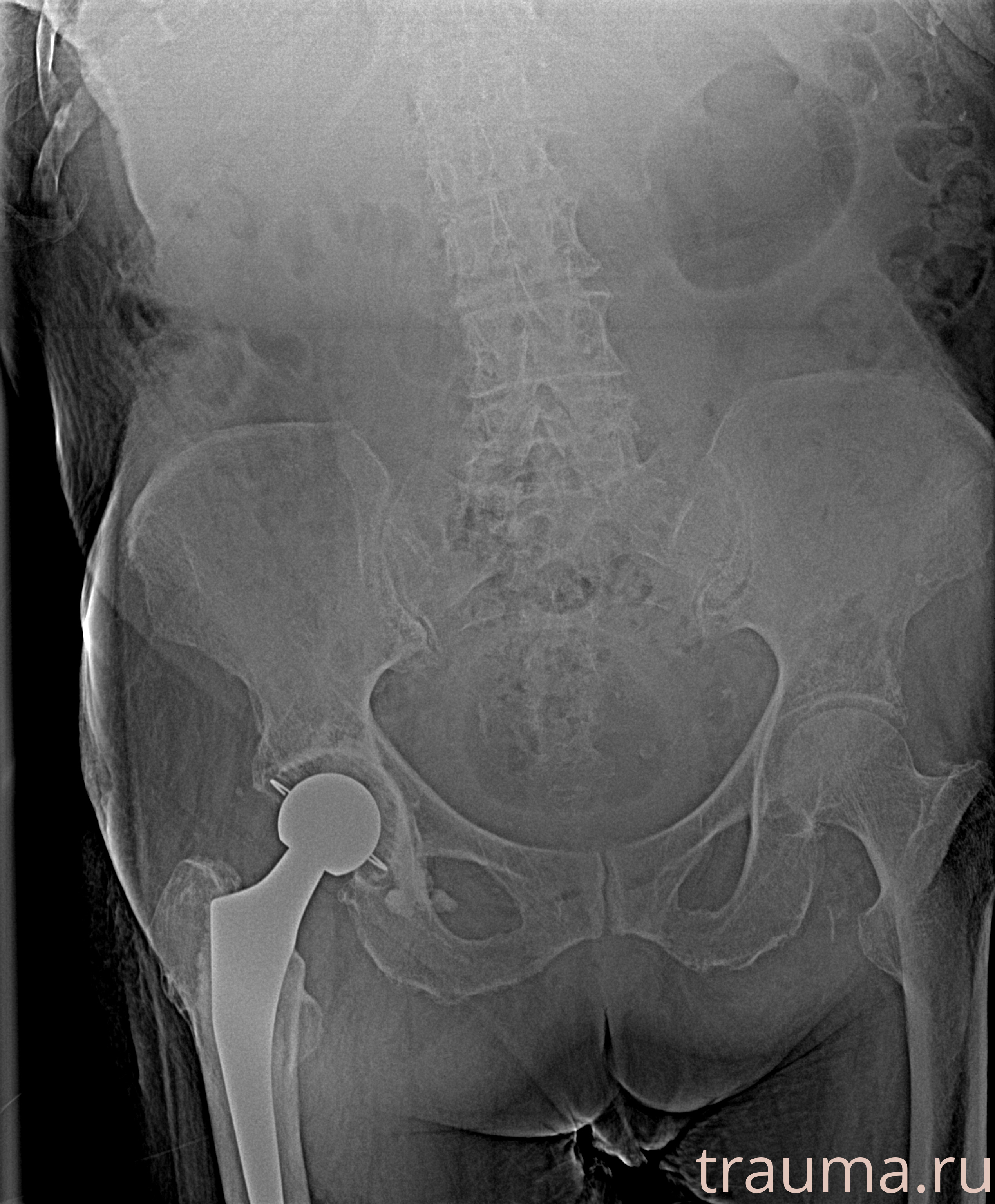 Рентген на дому: по вашему адресу приезжает врач-рентгенолог, травматолог-ортопед с мобильным рентгеновским аппаратом, проводит диагностику травмы или заболевания, делает необходимые рентгенограммы, дает рекомендации по дальнейшему лечению. Получить качественные снимки в домашних условиях возможно благодаря уникальной методике, разработанной МосРентген Центром для института  Склифосовского