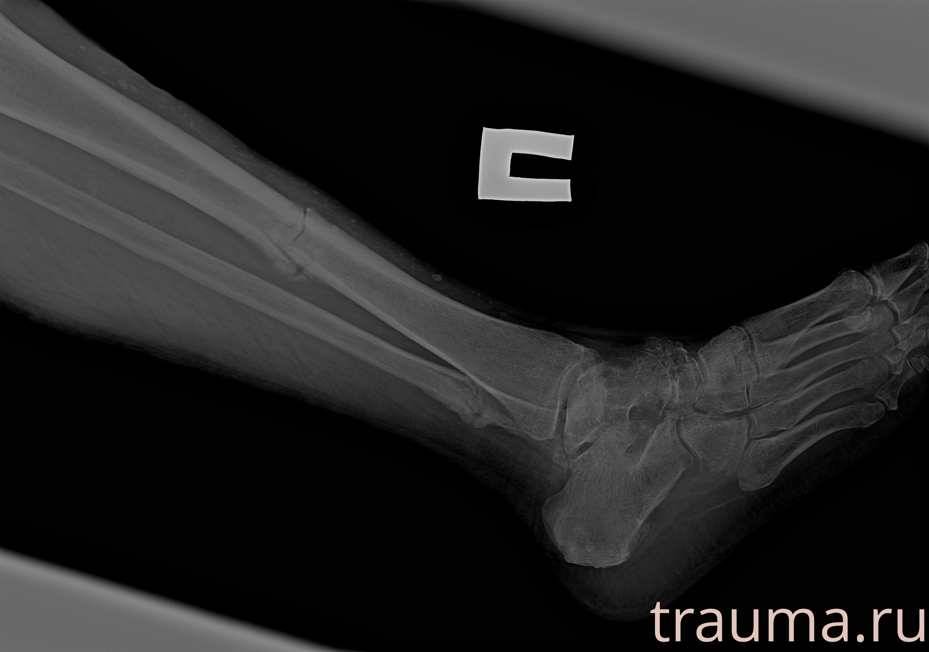 Рентген на дому: по вашему адресу приезжает врач-рентгенолог, травматолог-ортопед с мобильным рентгеновским аппаратом, проводит диагностику травмы или заболевания, делает необходимые рентгенограммы, дает рекомендации по дальнейшему лечению. Получить качественные снимки в домашних условиях возможно благодаря уникальной методике, разработанной МосРентген Центром для института  Склифосовского