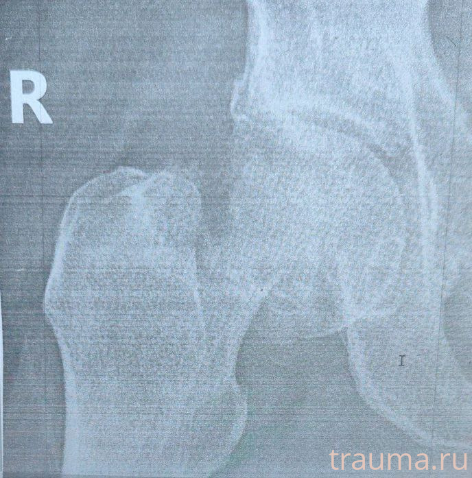 Рентген на дому: по вашему адресу приезжает врач-рентгенолог, травматолог-ортопед с мобильным рентгеновским аппаратом, проводит диагностику травмы или заболевания, делает необходимые рентгенограммы, дает рекомендации по дальнейшему лечению. Получить качественные снимки в домашних условиях возможно благодаря уникальной методике, разработанной МосРентген Центром для института  Склифосовского